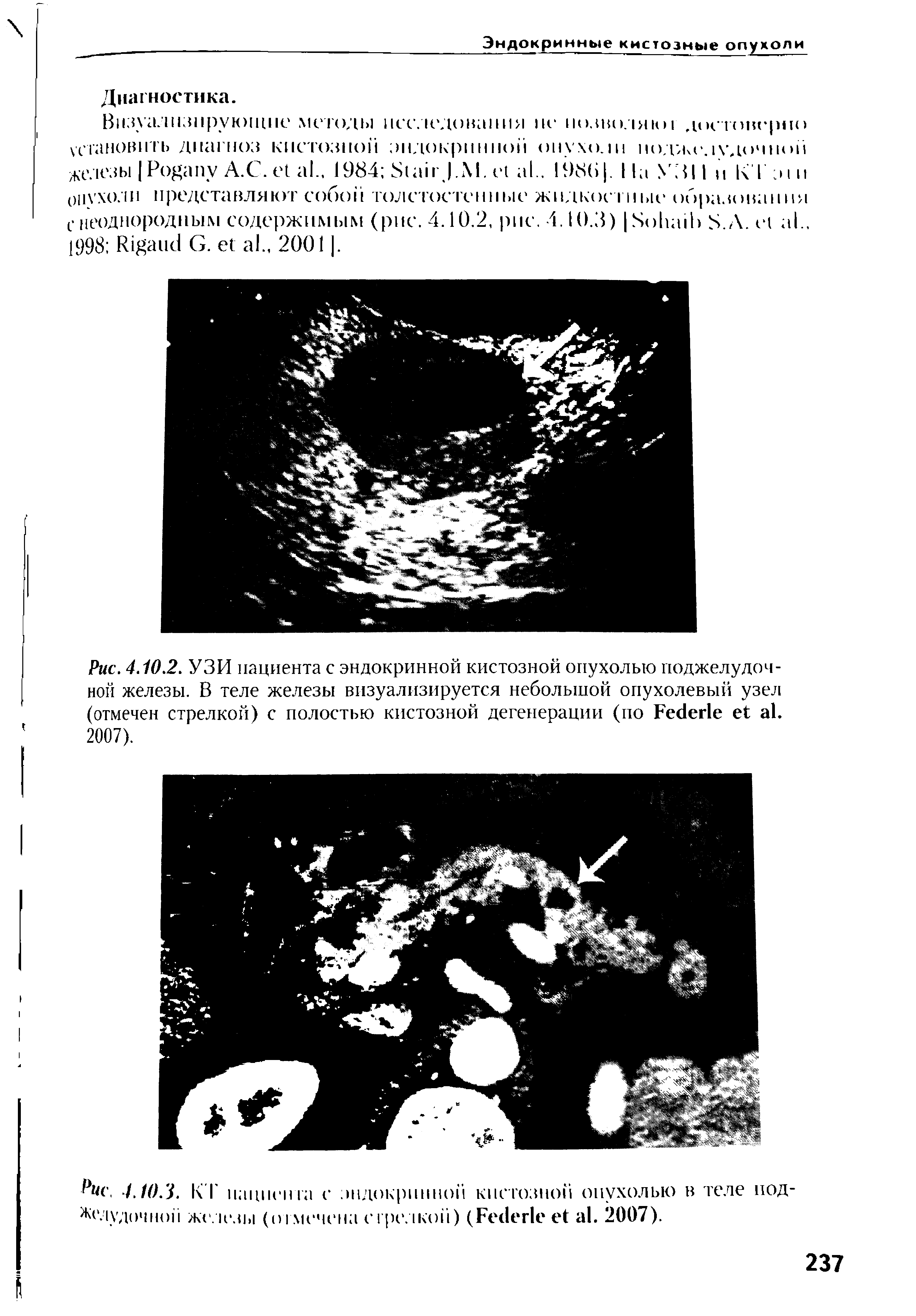 Рис. 4.10.2. УЗИ пациента с эндокринной кистозной опухолью поджелудочной железы. В теле железы визуализируется небольшой опухолевый узел (отмечен стрелкой) с полостью кистозной дегенерации (по Ре<1ег1е е1 а1. 2007).