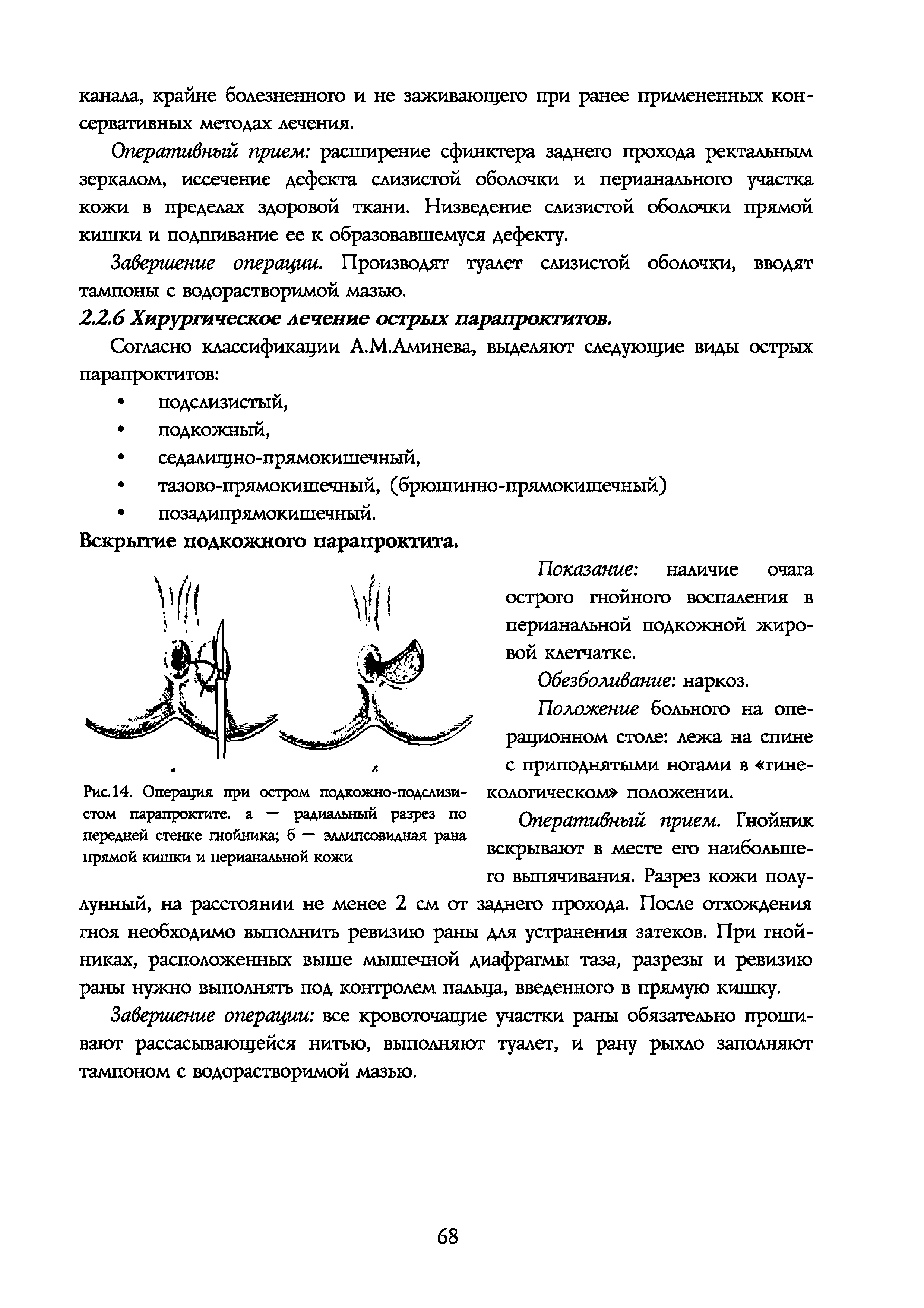 Рис.14. Операция при остром подкожно-подслизистом парапроктите, а — радиальный разрез по передней стенке гнойника б — эллипсовидная рана прямой кишки и перианальной кожи...