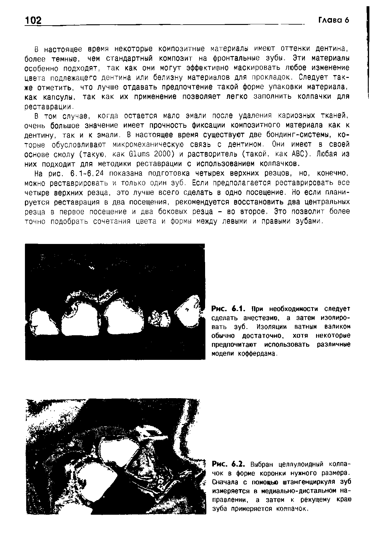 Рис. 6.2. Выбран целлулоидный колпачок в форме коронки нужного размера. Сначала с помощью штангенциркуля зуб измеряется в медиально-дистальном направлении, а затем к режущему краю зуба примеряется колпачок.