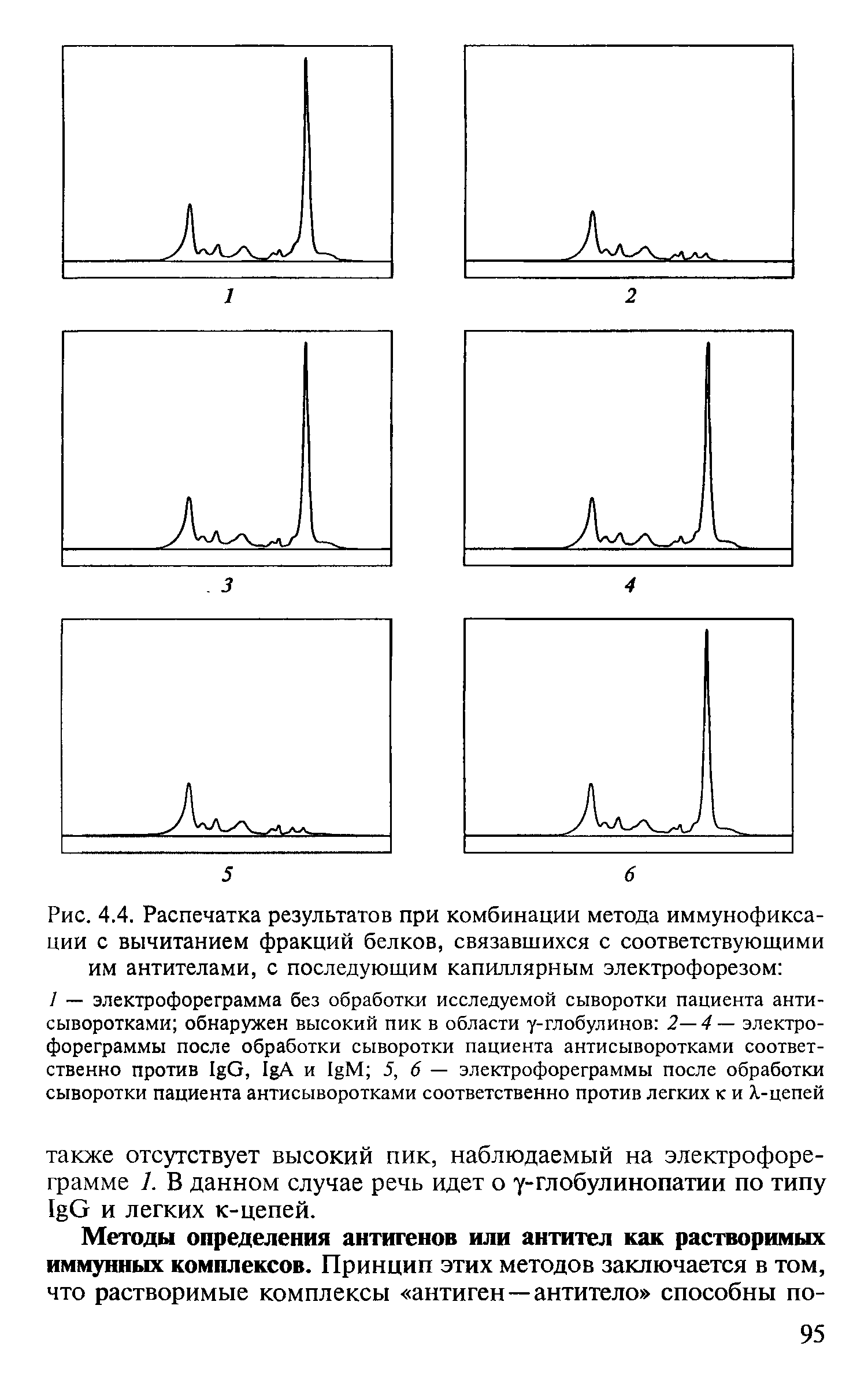 Рис. 4.4. Распечатка результатов при комбинации метода иммунофиксации с вычитанием фракций белков, связавшихся с соответствующими им антителами, с последующим капиллярным электрофорезом ...