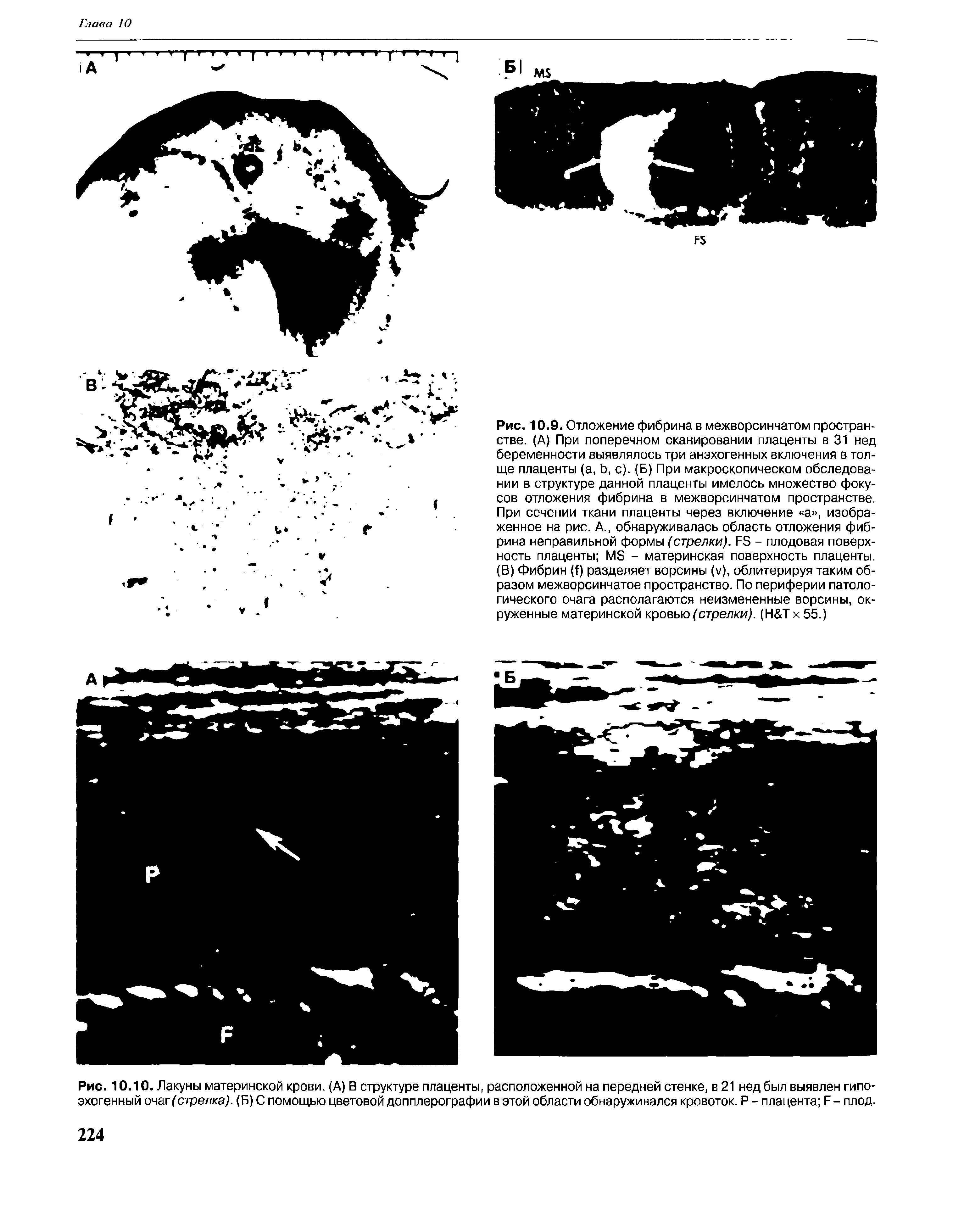 Рис. 10.10. Лакуны материнской крови. (А) В структуре плаценты, расположенной на передней стенке, в 21 нед был выявлен гипо-эхогенный очаг (стрелка). (Б) С помощью цветовой допплерографии в этой области обнаруживался кровоток. Р - плацента Б - плод.