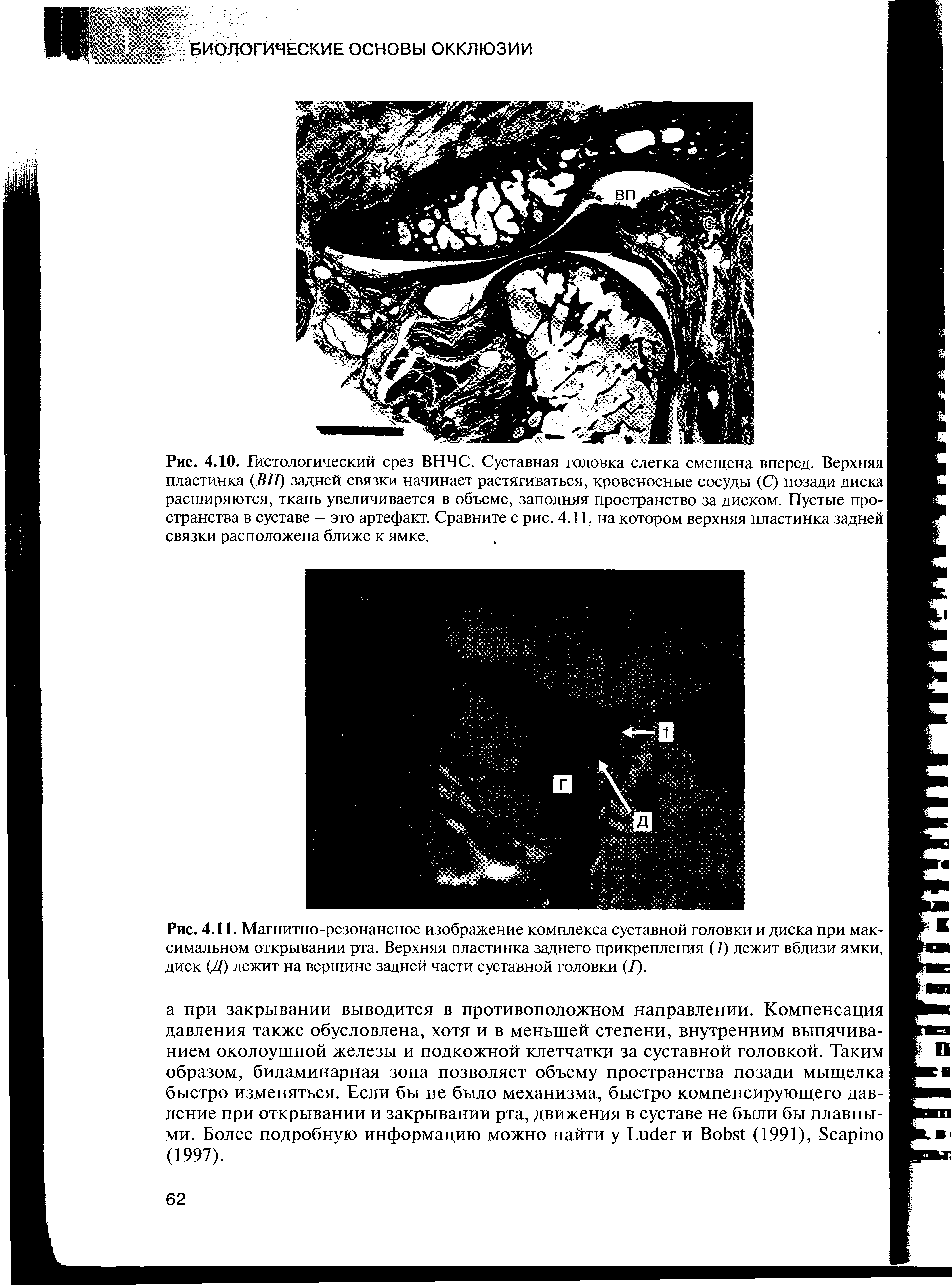 Рис. 4.11. Магнитно-резонансное изображение комплекса суставной головки и диска при максимальном открывании рта. Верхняя пластинка заднего прикрепления (7) лежит вблизи ямки, диск (Д) лежит на вершине задней части суставной головки (/).