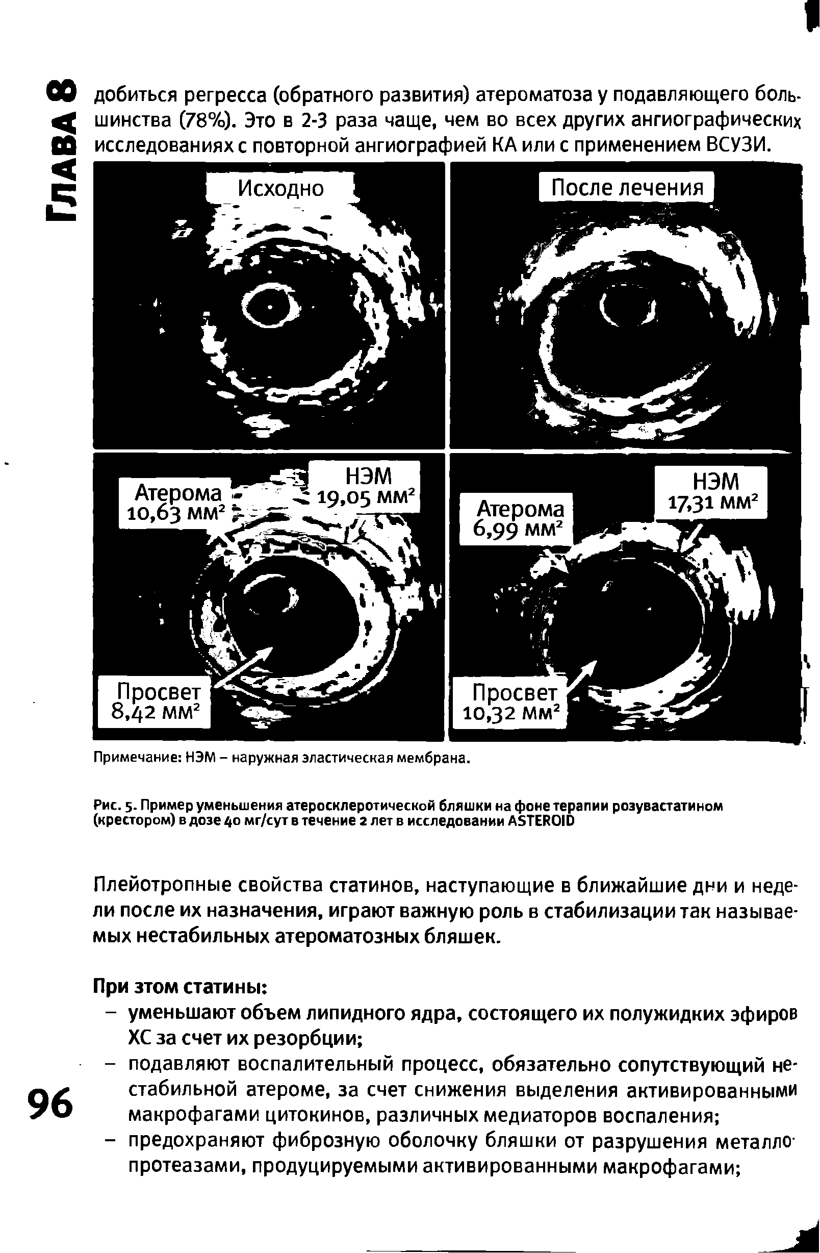 Рис. 5- Пример уменьшения атеросклеротической бляшки на фоне терапии розувастатином (крестором) в дозе 40 мг/сут в течение 2 лет в исследовании ASTEROID...