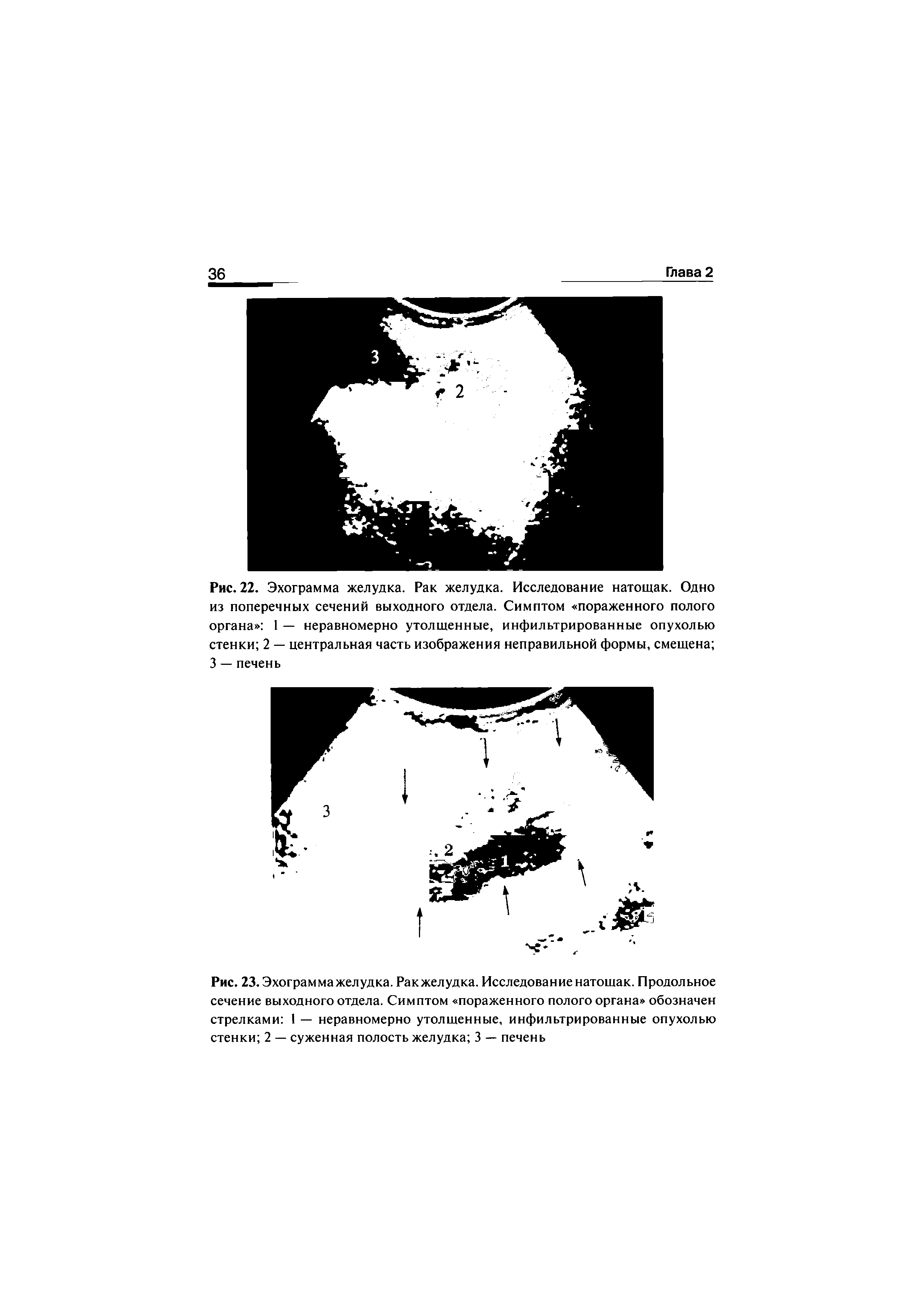 Рис. 22. Эхограмма желудка. Рак желудка. Исследование натощак. Одно из поперечных сечений выходного отдела. Симптом пораженного полого органа 1 — неравномерно утолщенные, инфильтрированные опухолью стенки 2 — центральная часть изображения неправильной формы, смещена 3 — печень...