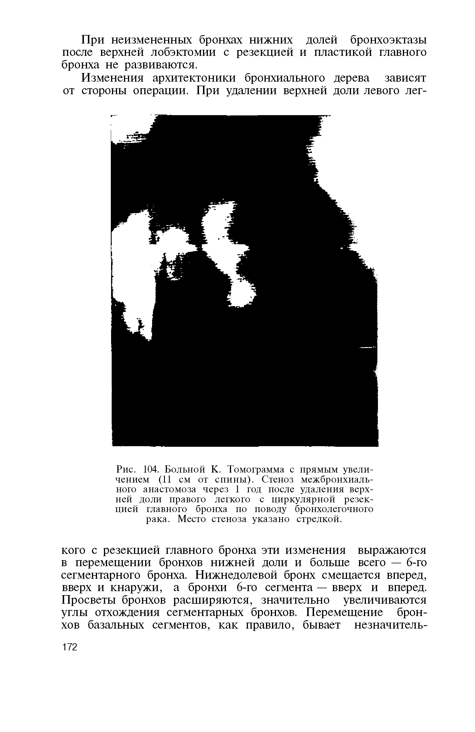 Рис. 104. Больной К. Томограмма с прямым увеличением (11 см от спины). Стеноз межбронхиального анастомоза через 1 год после удаления верхней доли правого легкого с циркулярной резекцией главного бронха по поводу бронхолегочного рака. Место стеноза указано стрелкой.