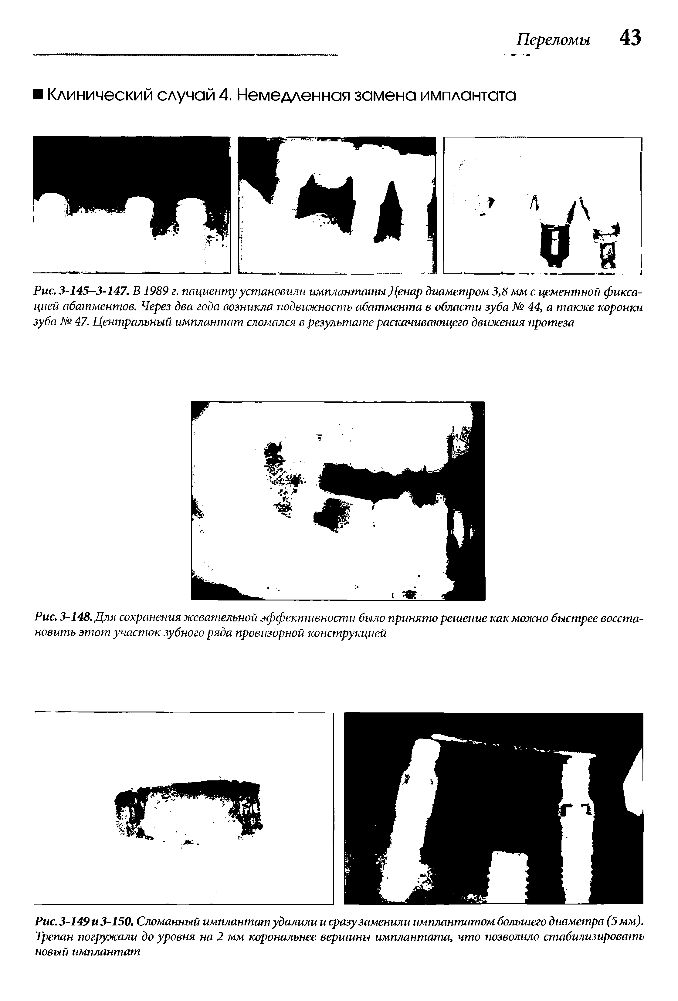 Рис. 3-145-3-147. В 1989 г. пациенту установили имплантаты Денар диаметром 3,8 мм с цементной фиксацией абатментов. Через два года возникла подвижность абатмента в области зуба № 44, а также коронки зуба № 47. Центральный имплантат сломался в результате раскачивающего движения протеза...