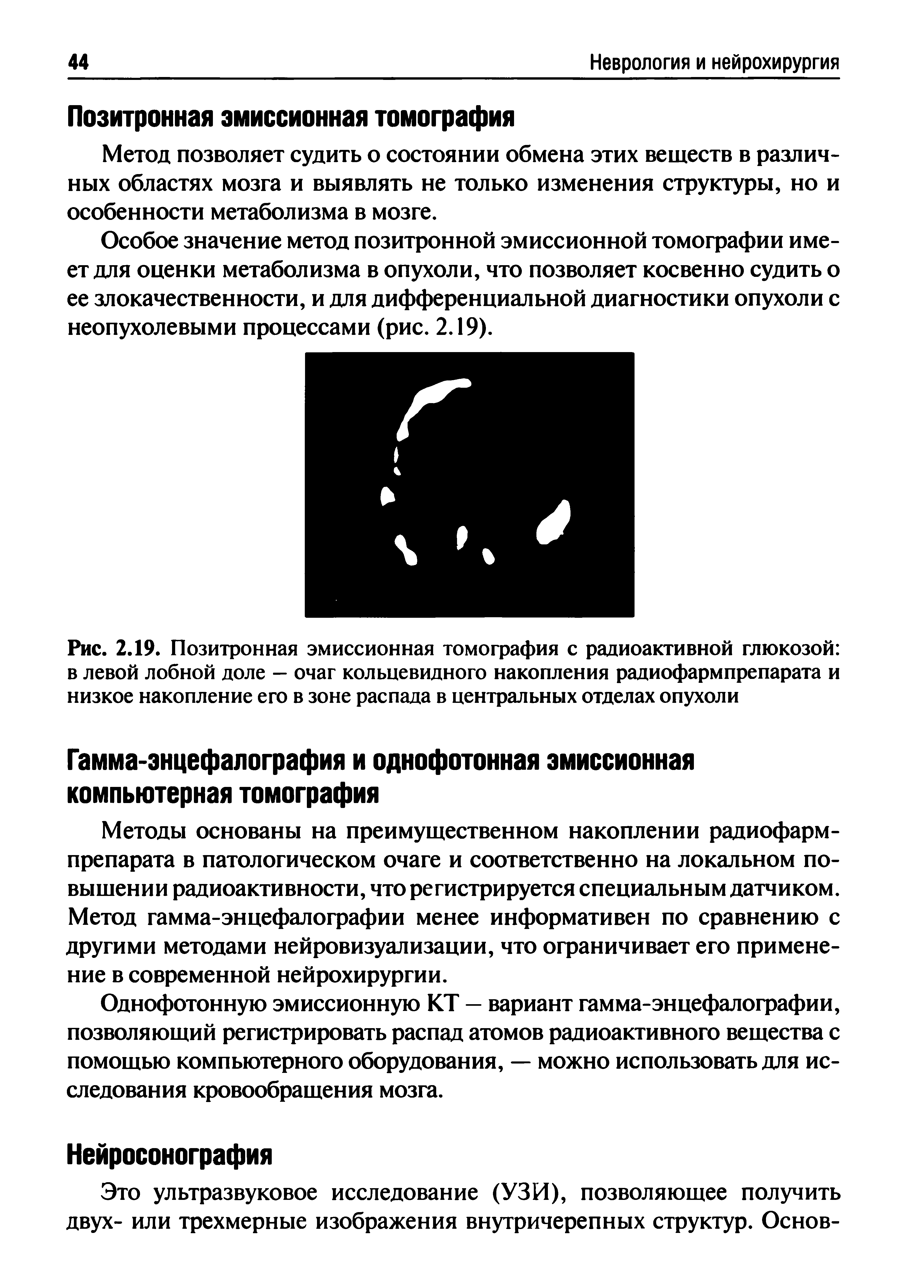 Рис. 2.19. Позитронная эмиссионная томография с радиоактивной глюкозой в левой лобной доле — очаг кольцевидного накопления радиофармпрепарата и низкое накопление его в зоне распада в центральных отделах опухоли...