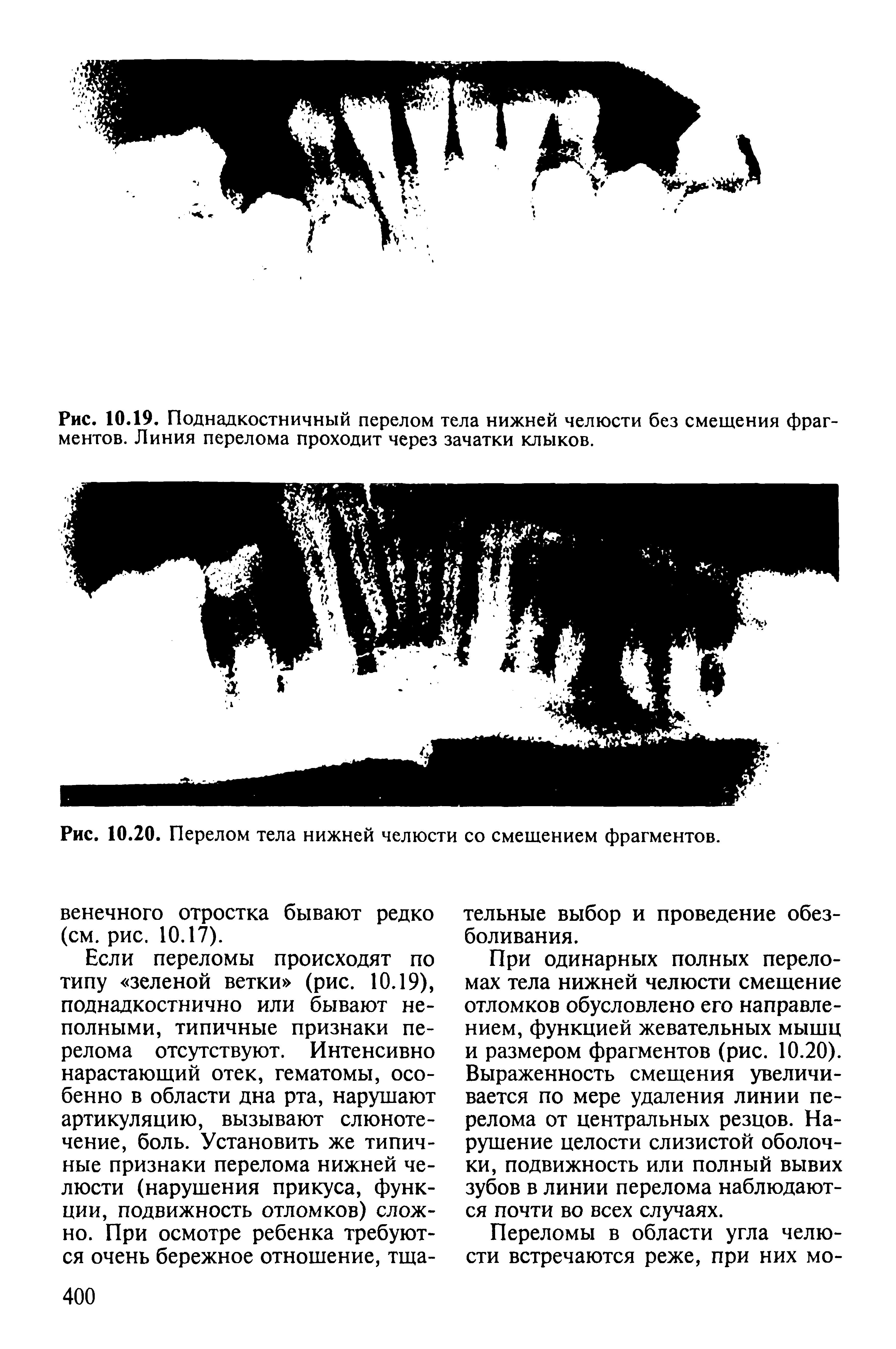 Рис. 10.20. Перелом тела нижней челюсти со смещением фрагментов.