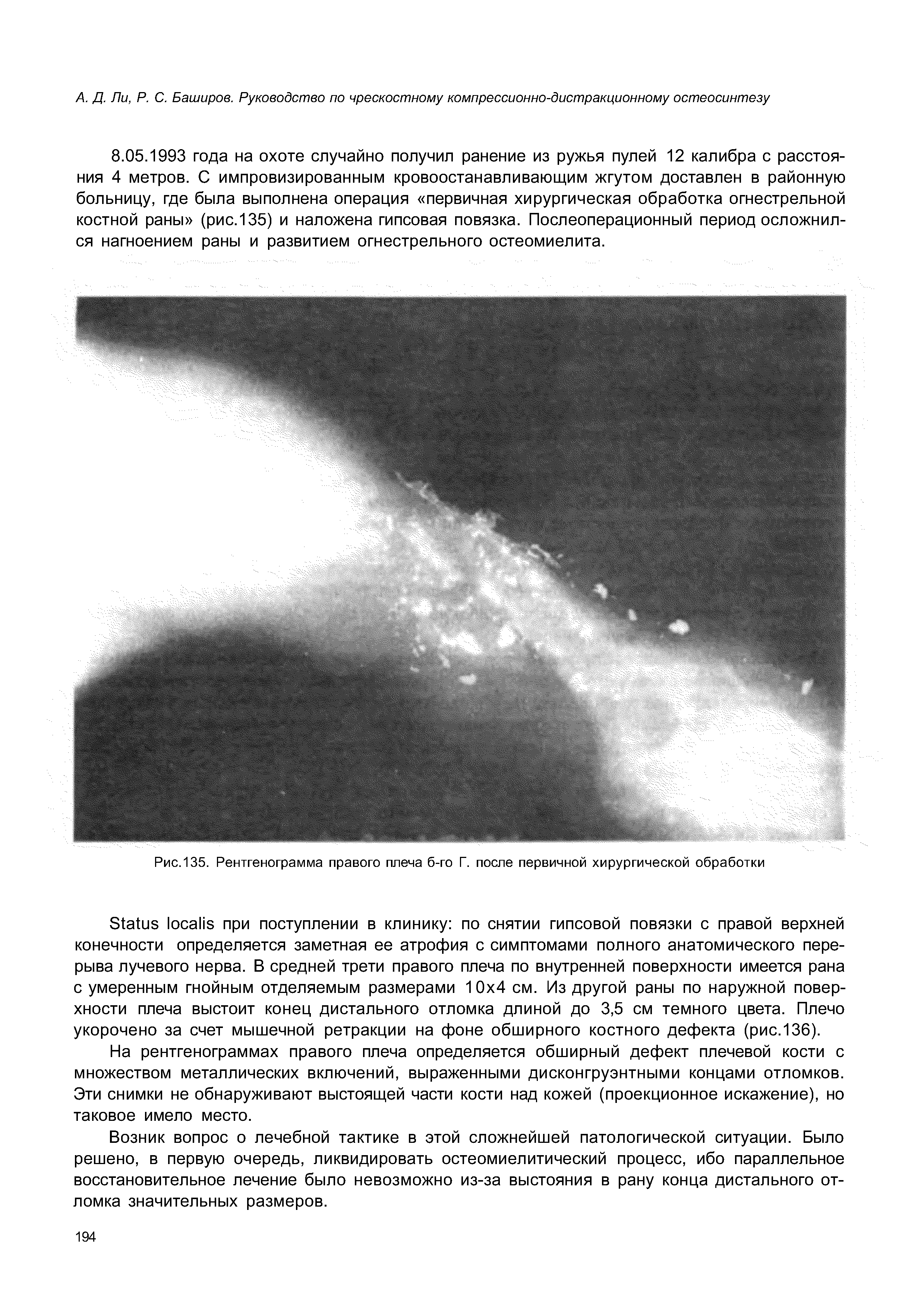 Рис. 135. Рентгенограмма правого плеча б-го Г. после первичной хирургической обработки...