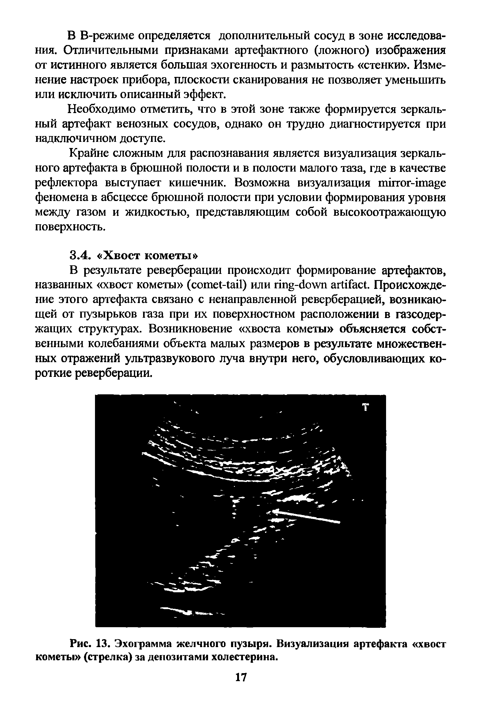 Рис. 13. Эхограмма желчного пузыря. Визуализация артефакта хвост кометы (стрелка) за депозитами холестерина.