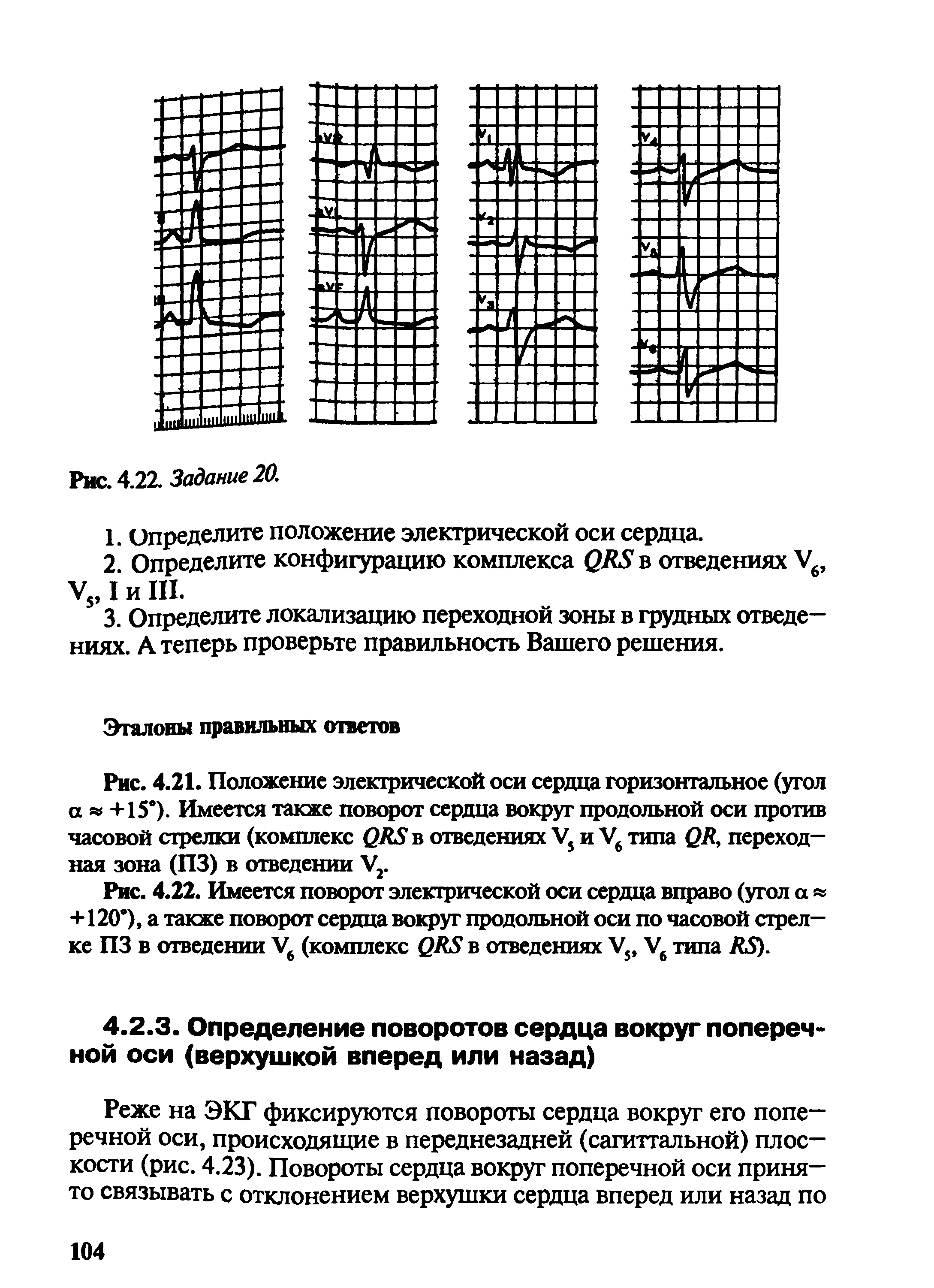 Рис. 4.22. Имеется поворот электрической оси сердца вправо (угол а +120 ), а также поворот сердца вокруг продольной оси по часовой стрелке ПЗ в отведении Уб (комплекс ( ЯЯ в отведениях У5, У6 типа Л5).