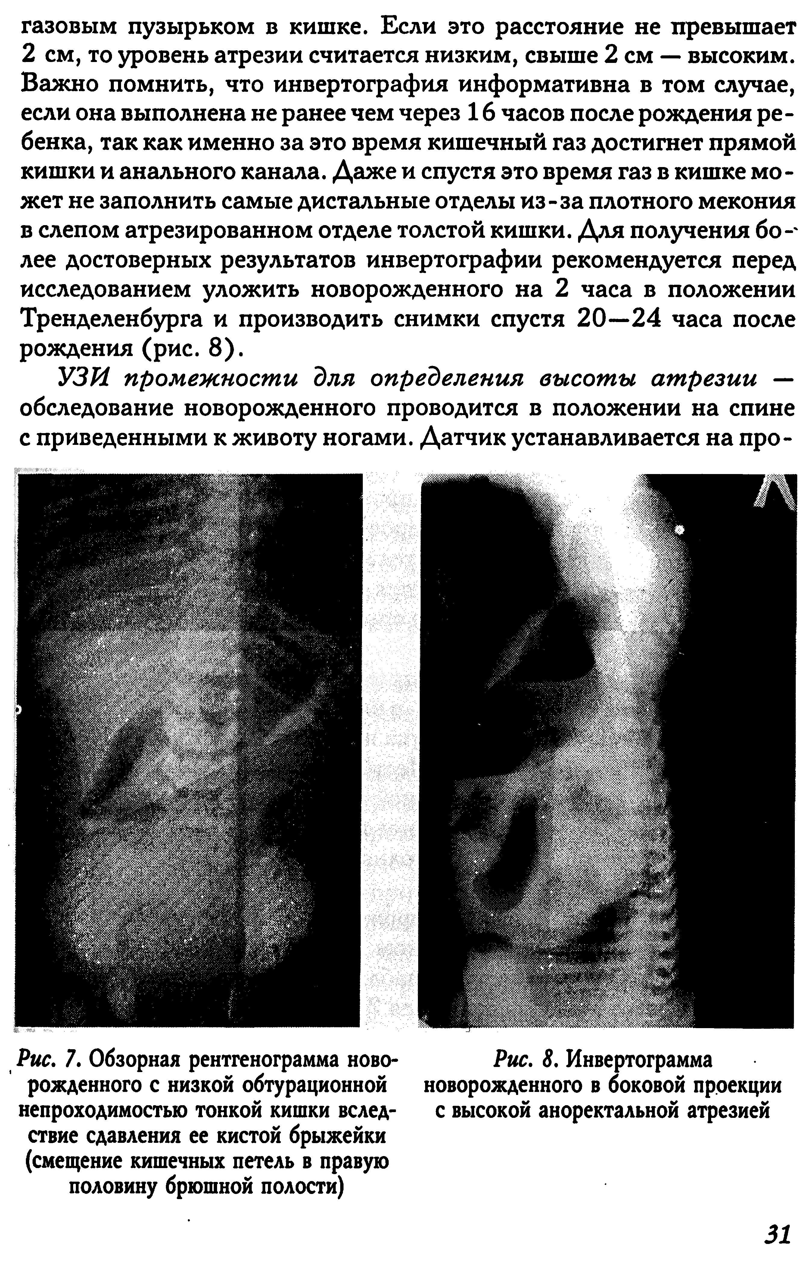 Рис. 7. Обзорная рентгенограмма новорожденного с низкой обтурационной непроходимостью тонкой кишки вследствие сдавления ее кистой брыжейки (смещение кишечных петель в правую половину брюшной полости)...