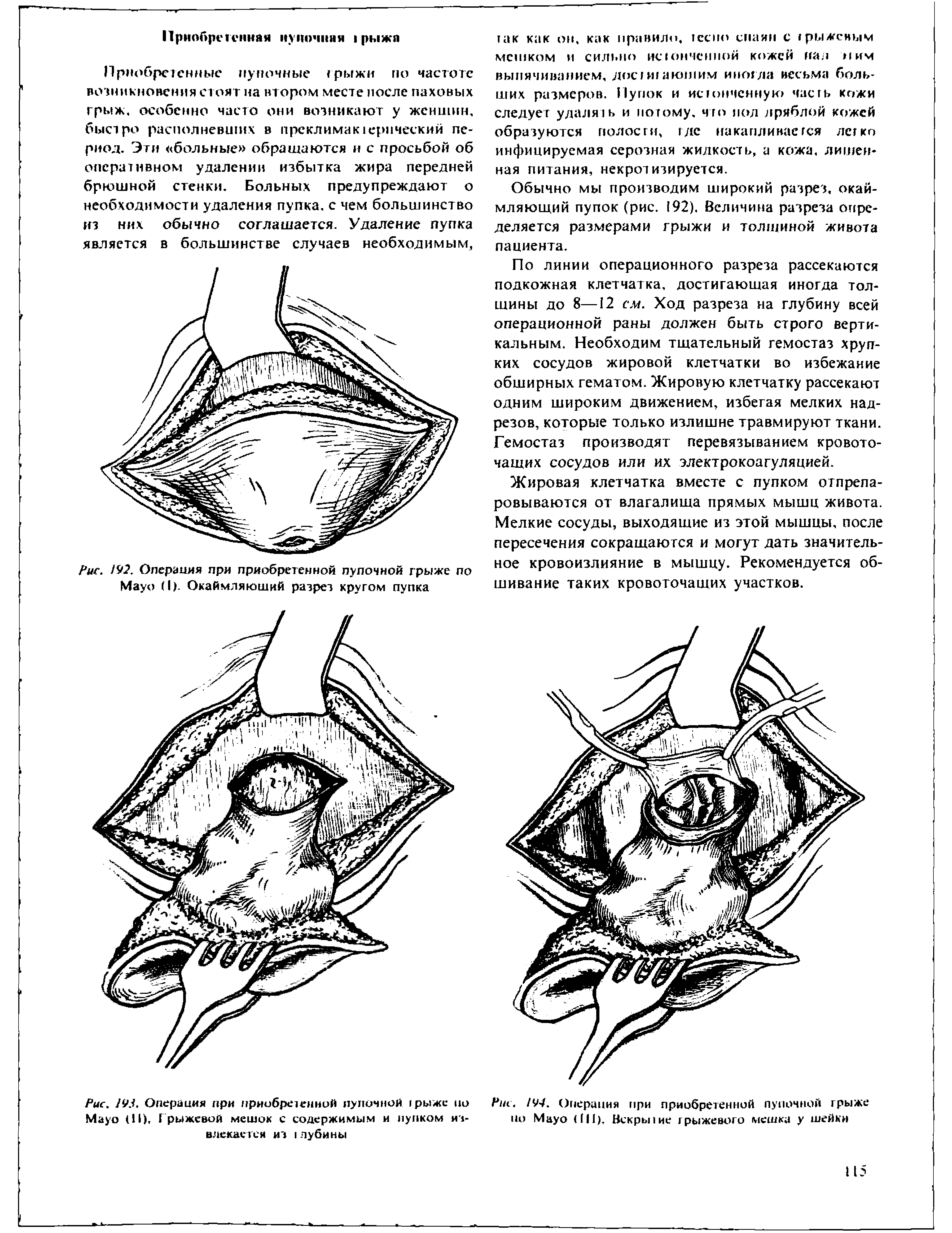 Рис. 92. Операция при приобретенной пупочной грыже по M (I). Окаймляющий разрез кругом пупка...