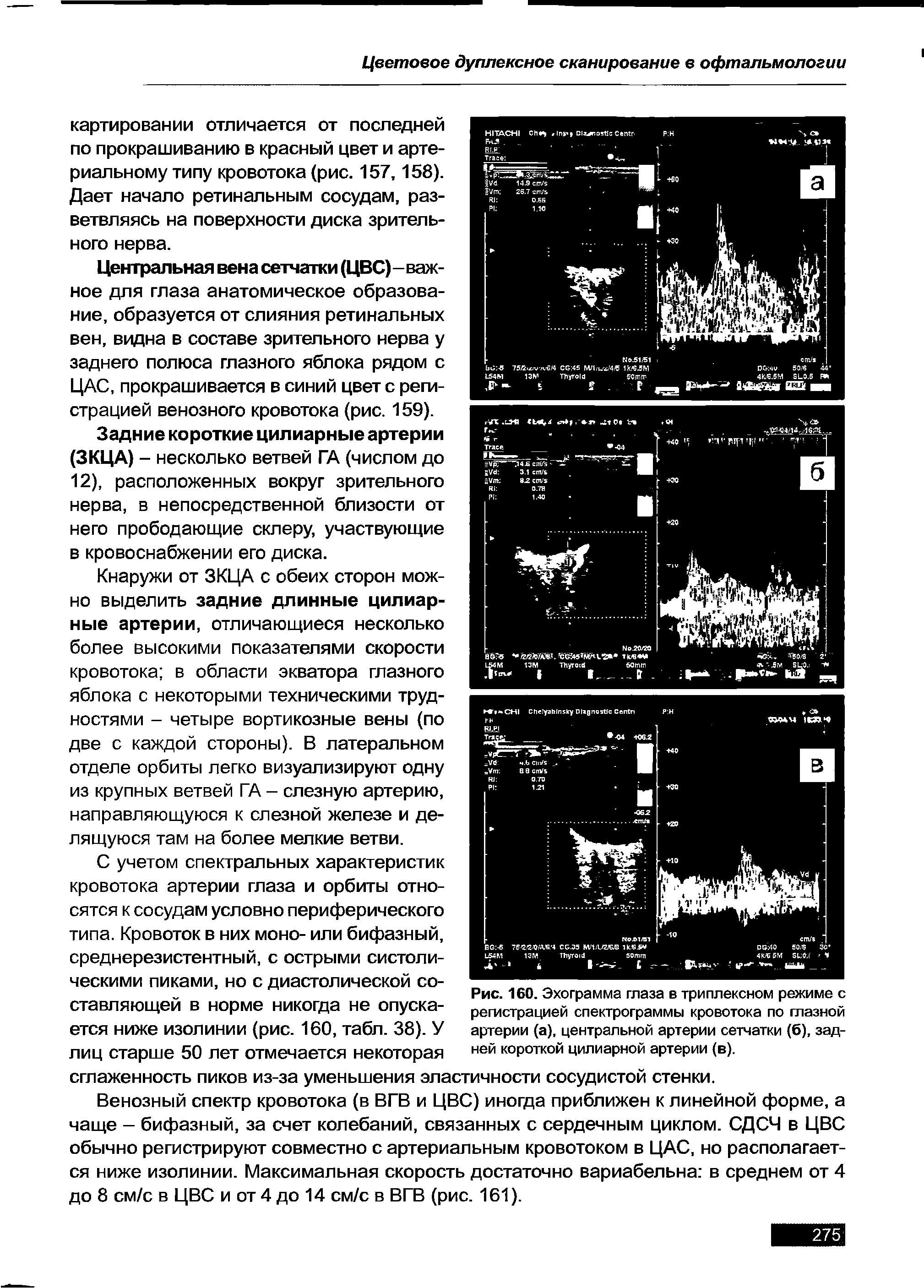 Рис. 160. Эхограмма глаза в триплексном режиме с регистрацией спектрограммы кровотока по глазной артерии (а), центральной артерии сетчатки (б), задней короткой цилиарной артерии (в).