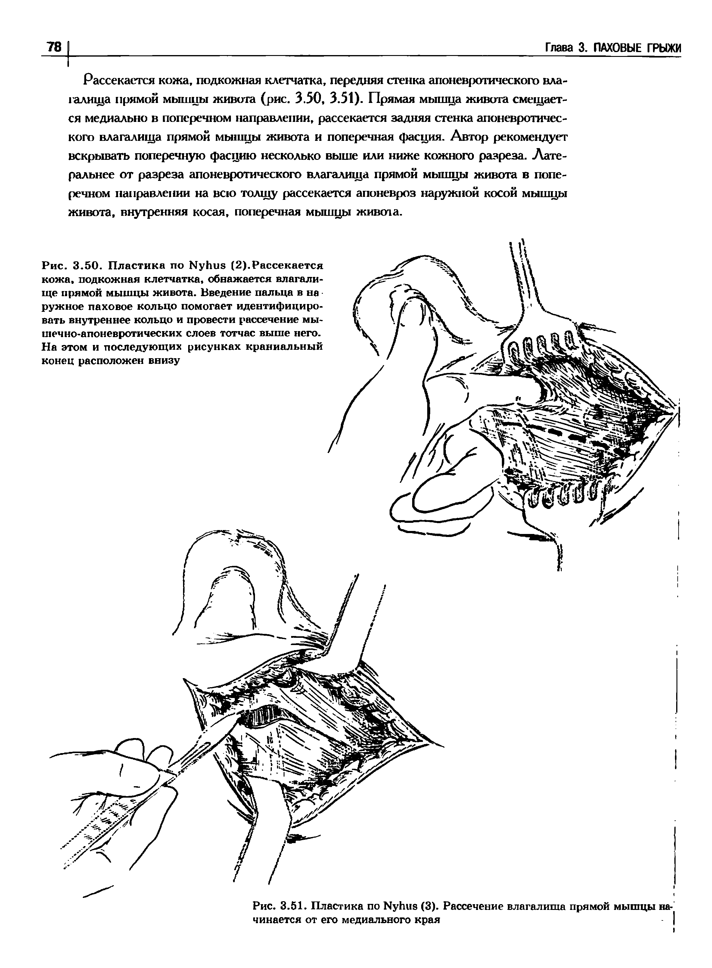 Рис. 3.50. Пластика по ЫуЬив (2).Рассекается кожа, подкожная клетчатка, обнажается влагалище прямой мышцы живота. Введение пальца в на -ружное паховое кольцо помогает идентифицировать внутреннее кольцо и провести рассечение мышечно-апоневротических слоев тотчас выше него. На этом и последующих рисунках краниальный конец расположен...