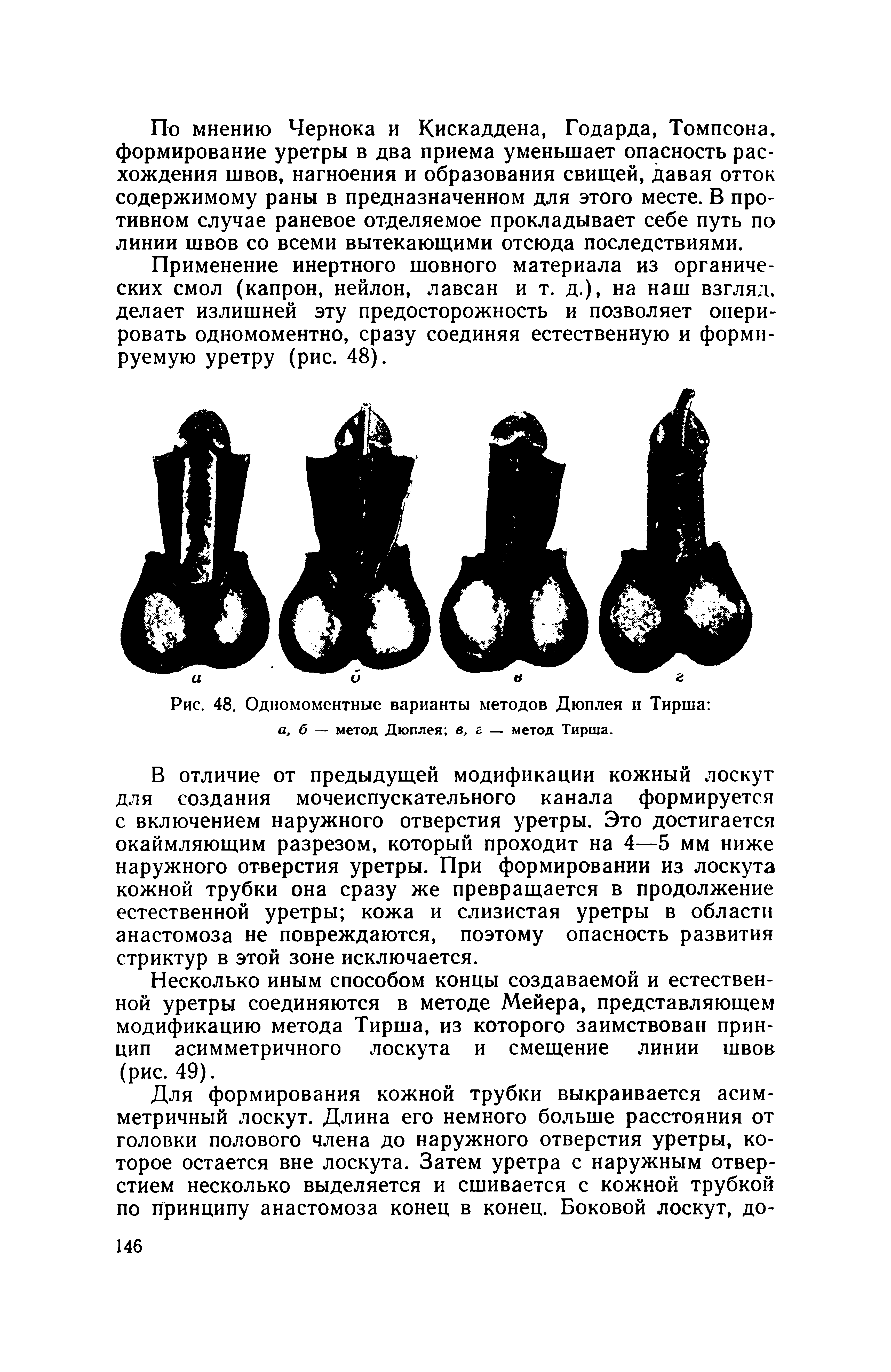 Рис. 48. Одномоментные варианты методов Дюплея и Тирша а, б — метод Дюплея в, г — метод Тирша.