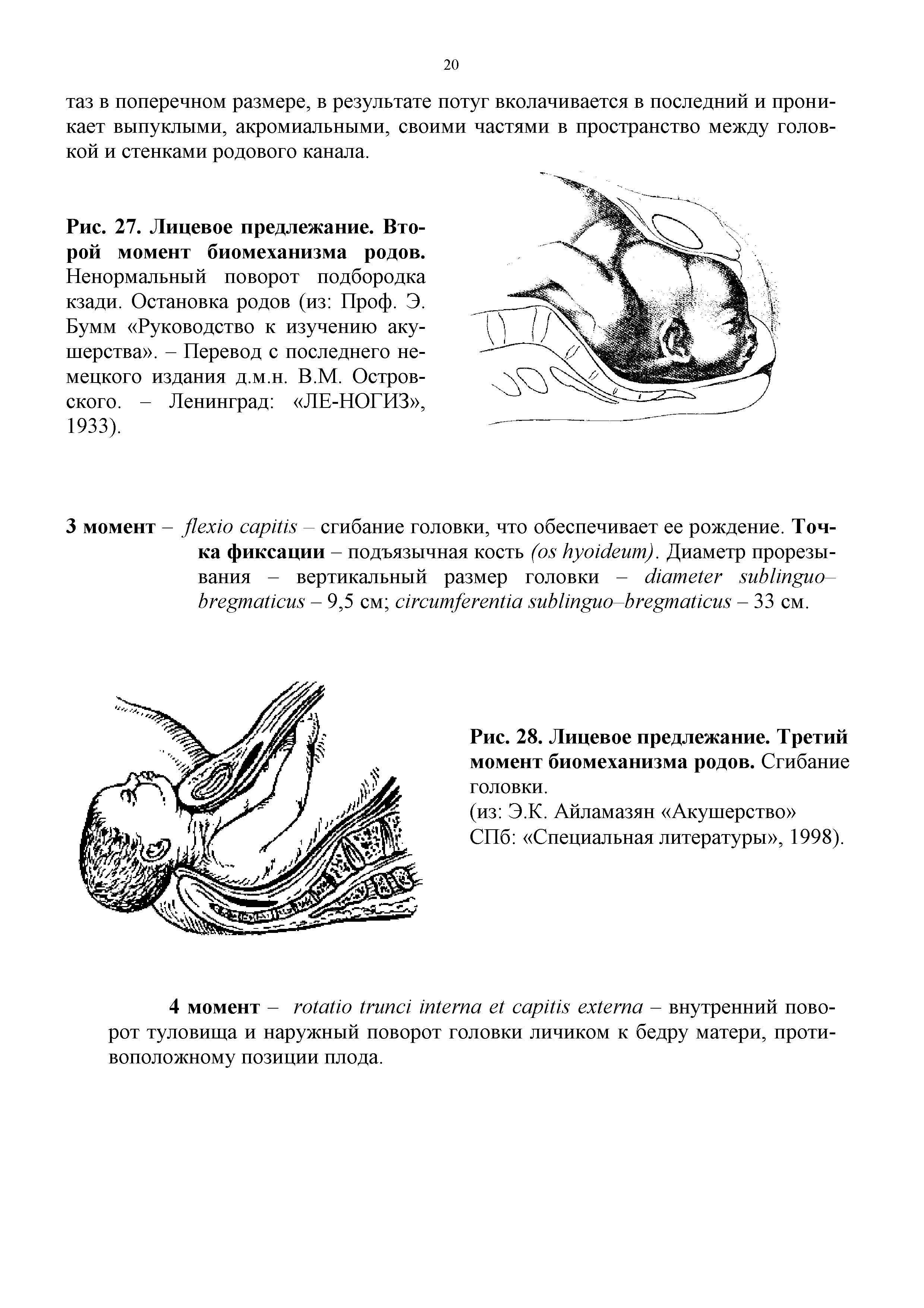 Рис. 27. Лицевое предлежание. Второй момент биомеханизма родов. Ненормальный поворот подбородка кзади. Остановка родов (из Проф. Э. Бумм Руководство к изучению акушерства . - Перевод с последнего немецкого издания д.м.н. В.М. Островского. - Ленинград ЛЕ-НОГИЗ , 1933).