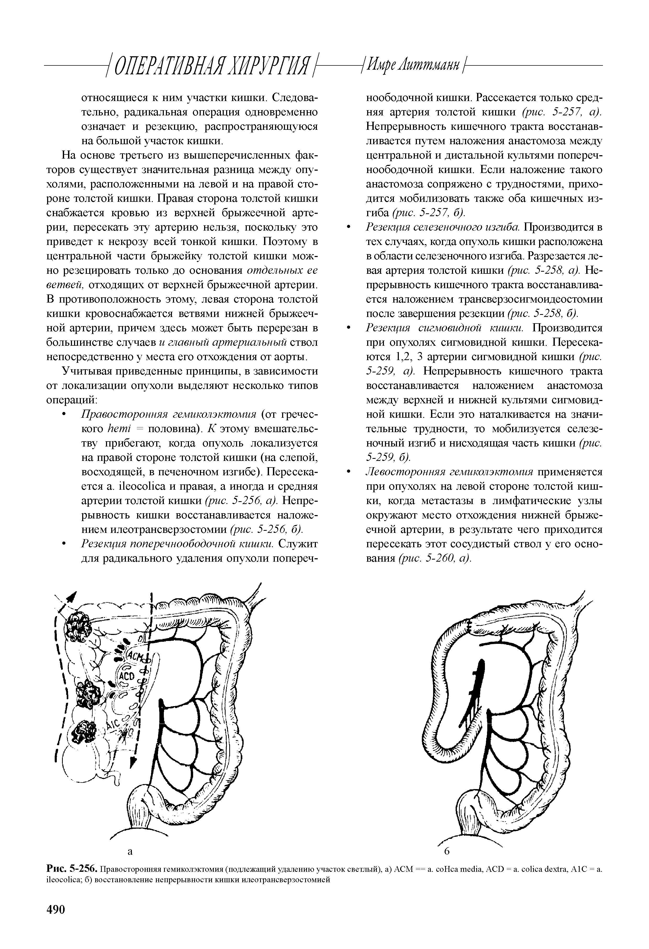 Рис. 5-256. Правосторонняя гемиколэктомия (подлежащий удалению участок светлый), а) АСМ == а. соНса , ACD = . , А1С = а. б) восстановление непрерывности кишки илеотрансверзостомией...