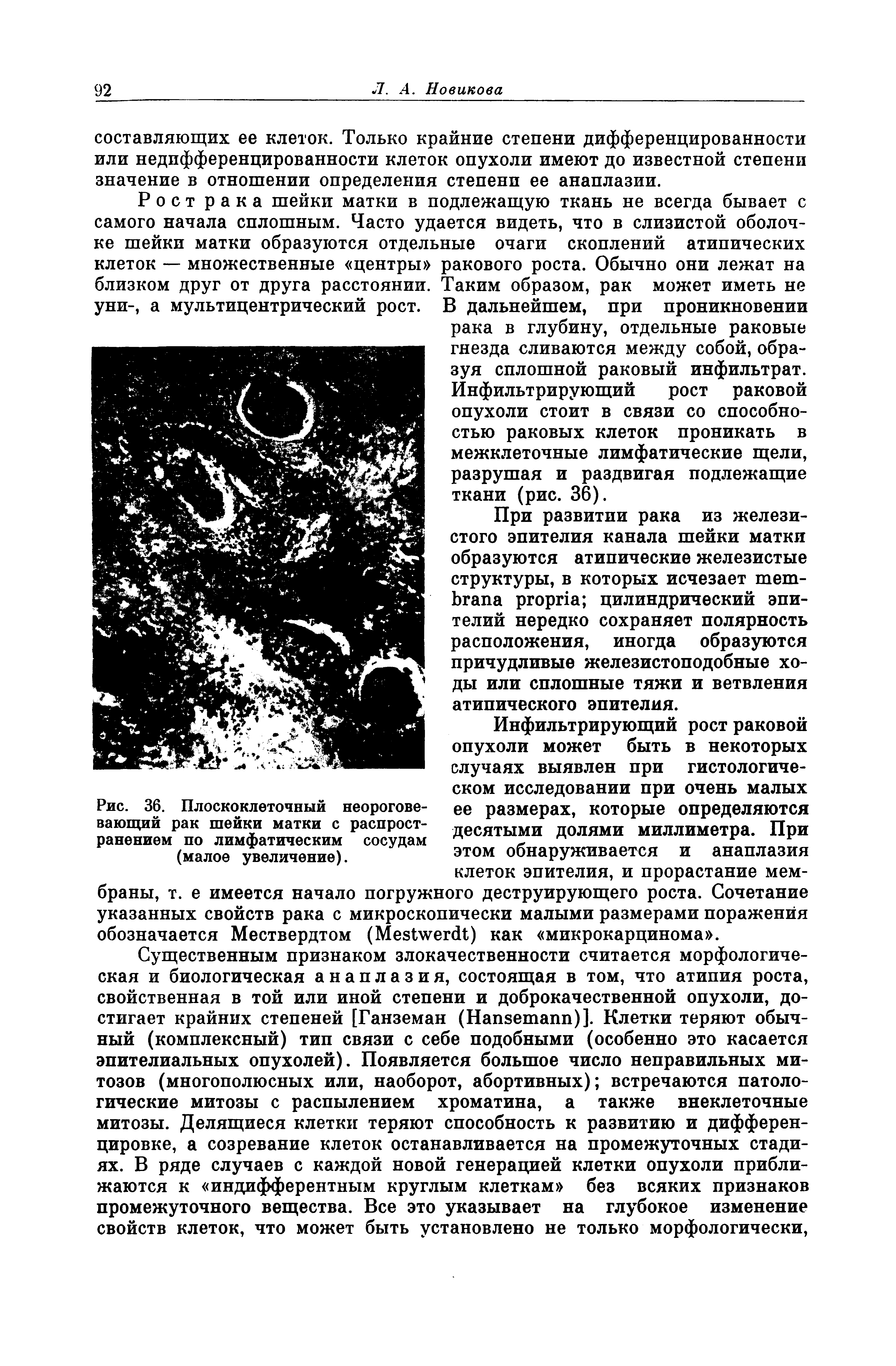 Рис. 36. Плоскоклеточный неорогове-вающий рак шейки матки с распространением по лимфатическим сосудам (малое увеличение).