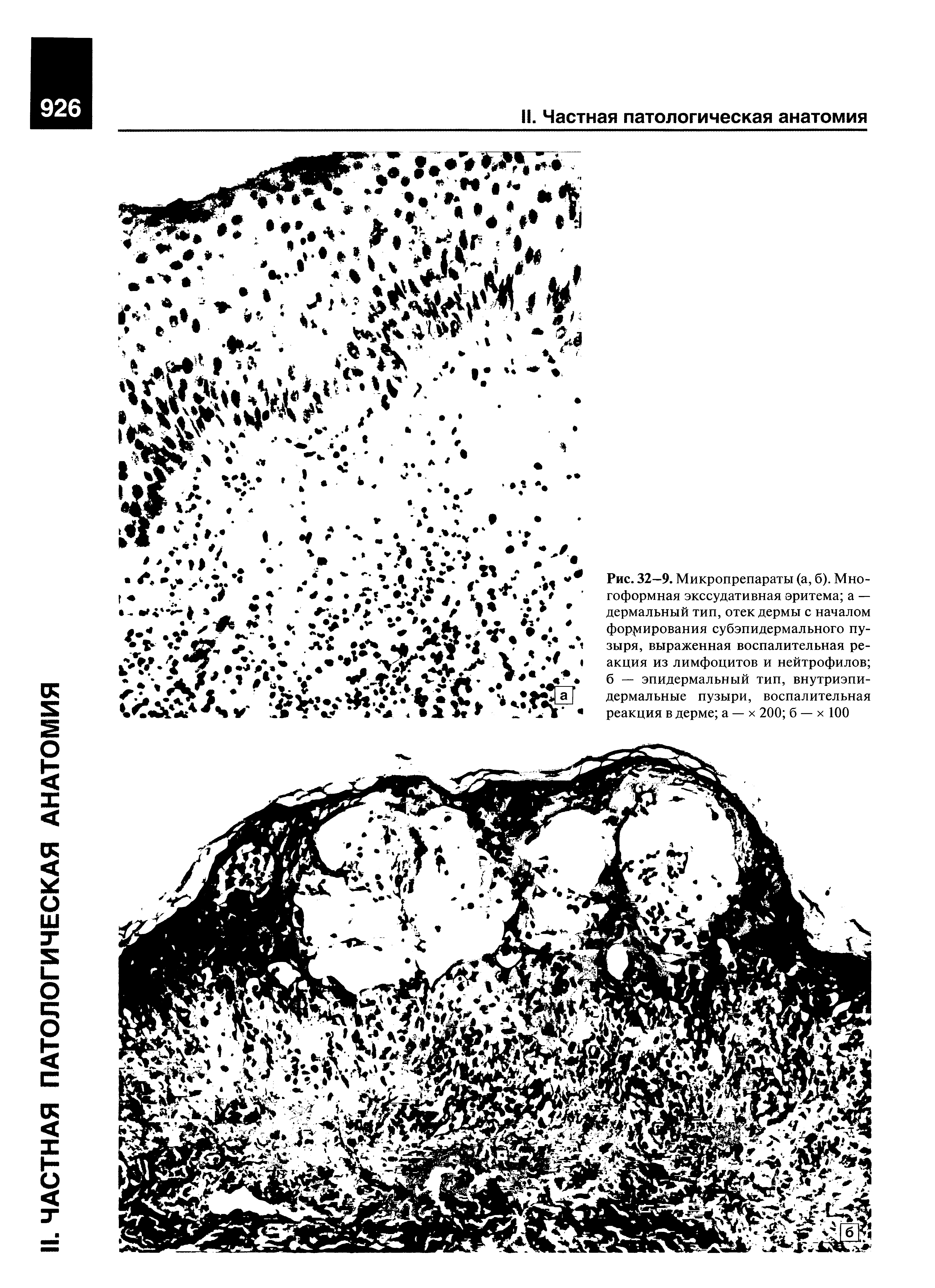 Рис. 32—9. Микропрепараты (а, б). Многоформная экссудативная эритема а — дермальный тип, отек дермы с началом формирования субэпидермального пузыря, выраженная воспалительная реакция из лимфоцитов и нейтрофилов б — эпидермальный тип, внутриэпидермальные пузыри, воспалительная реакция в дерме а — х 200 б — х 100...