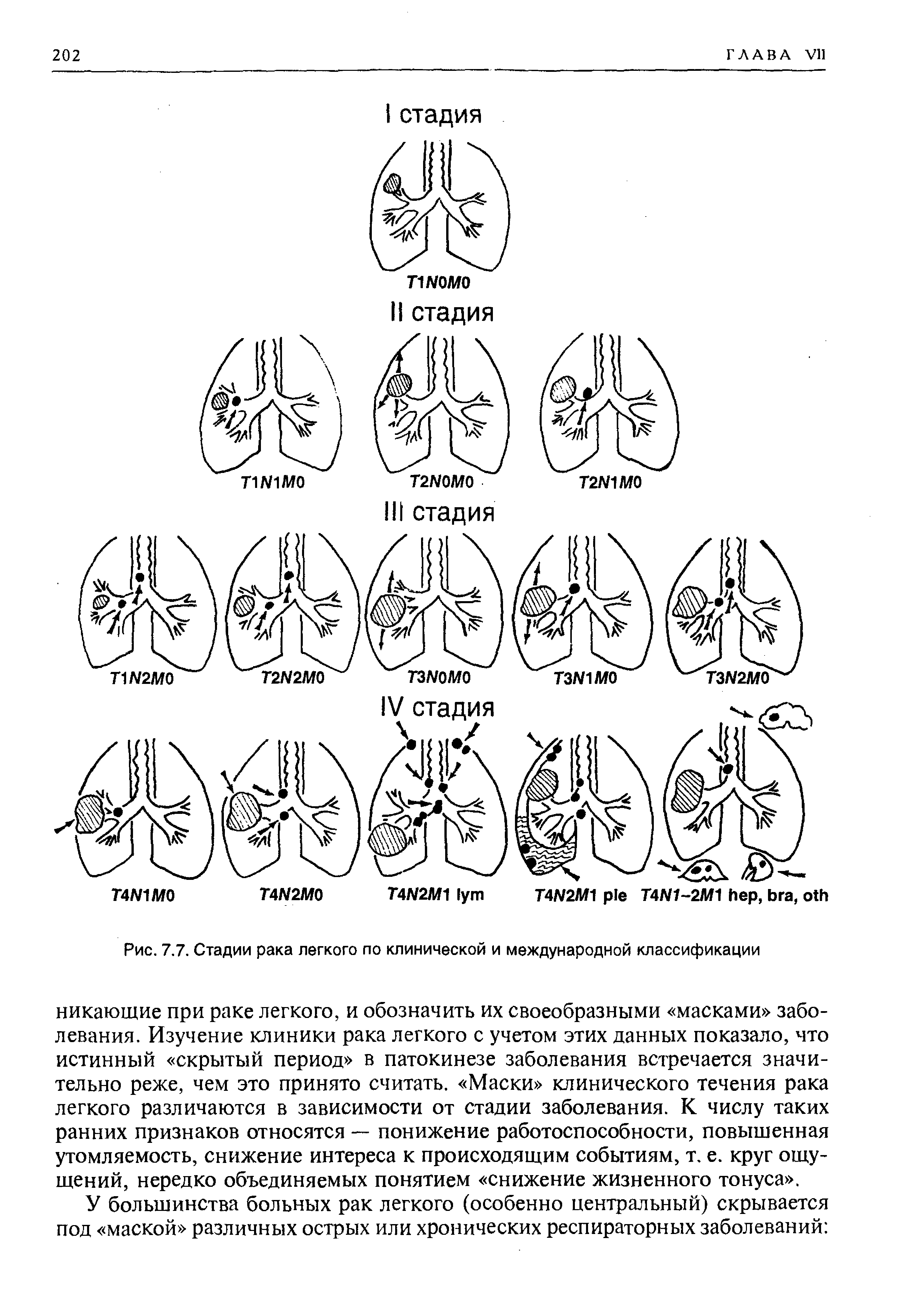 Рис. 7.7. Стадии рака легкого по клинической и международной классификации...