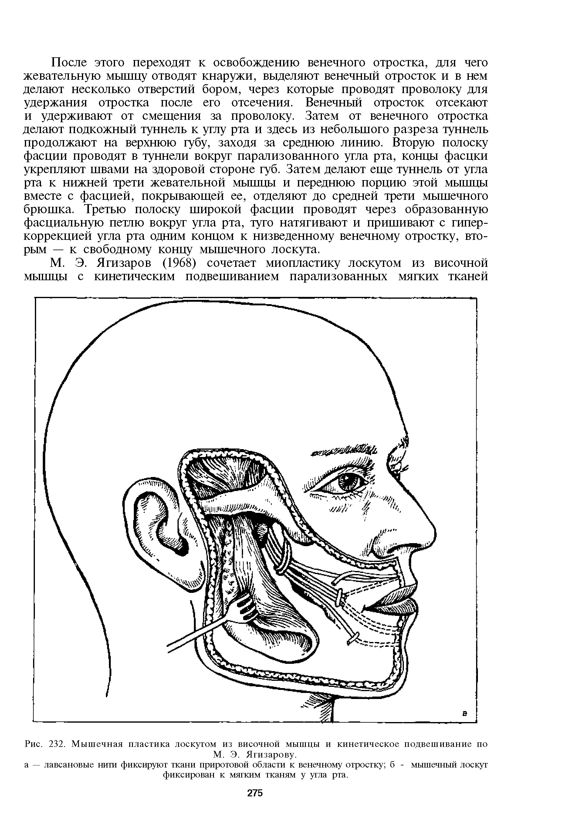 Рис. 232. Мышечная пластика лоскутом из височной мышцы и кинетическое подвешивание по М. Э. Ягизарову.