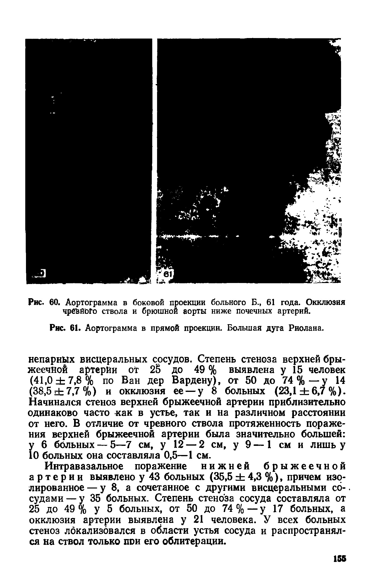 Рис. 61. Аортограмма в прямой проекции. Большая дуга Риолана.