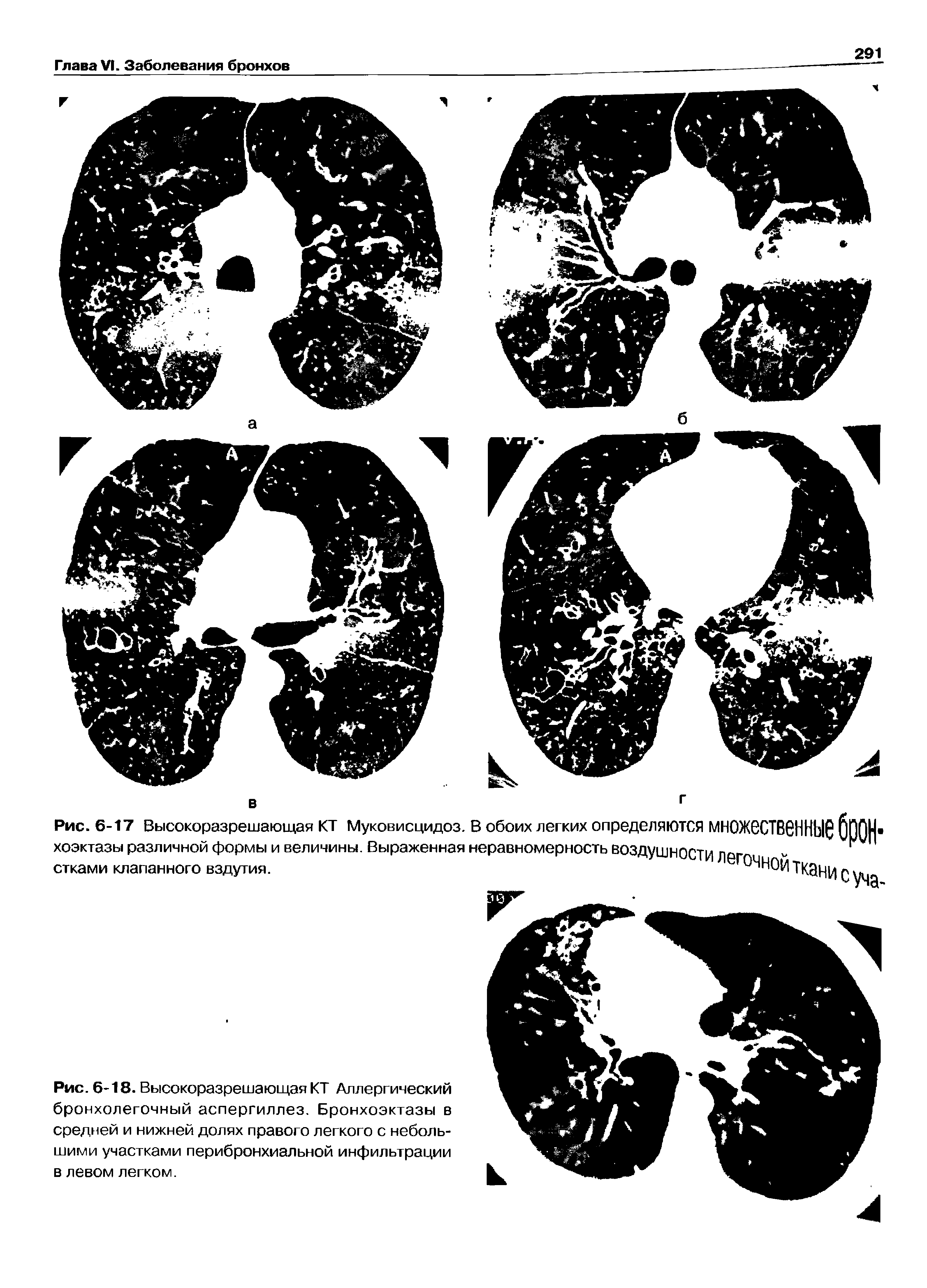 Рис. 6-18. Высокоразрешающая КТ Аллергический бронхолегочный аспергиллез. Бронхоэктазы в средней и нижней долях правого легкого с небольшими участками перибронхиальной инфильтрации в левом легком.