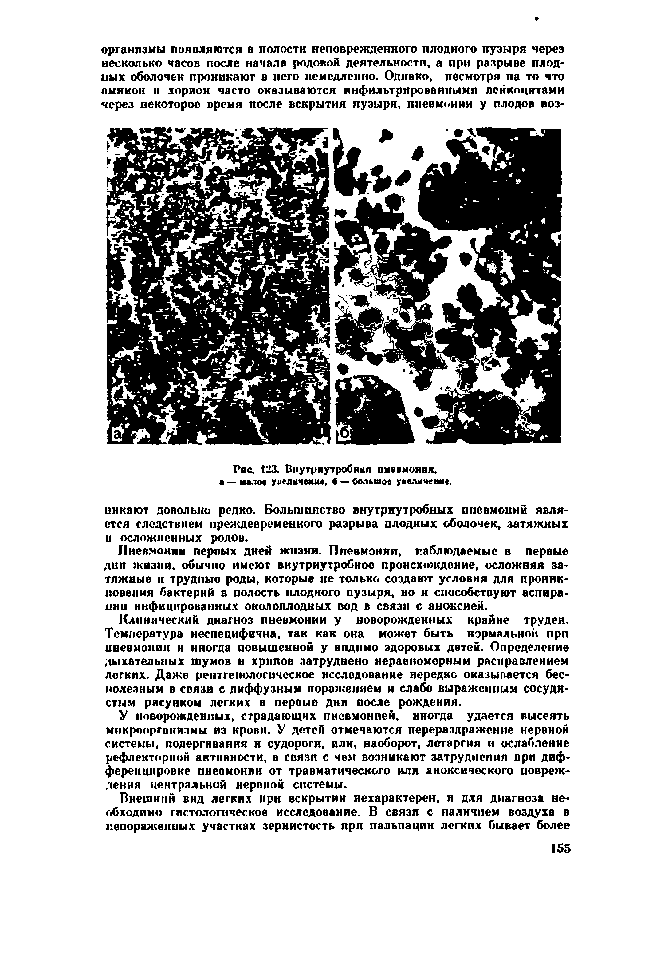 Рис. 123. Внутриутробная пневмония, а — малое уиелвчение. б — большое увеличение.
