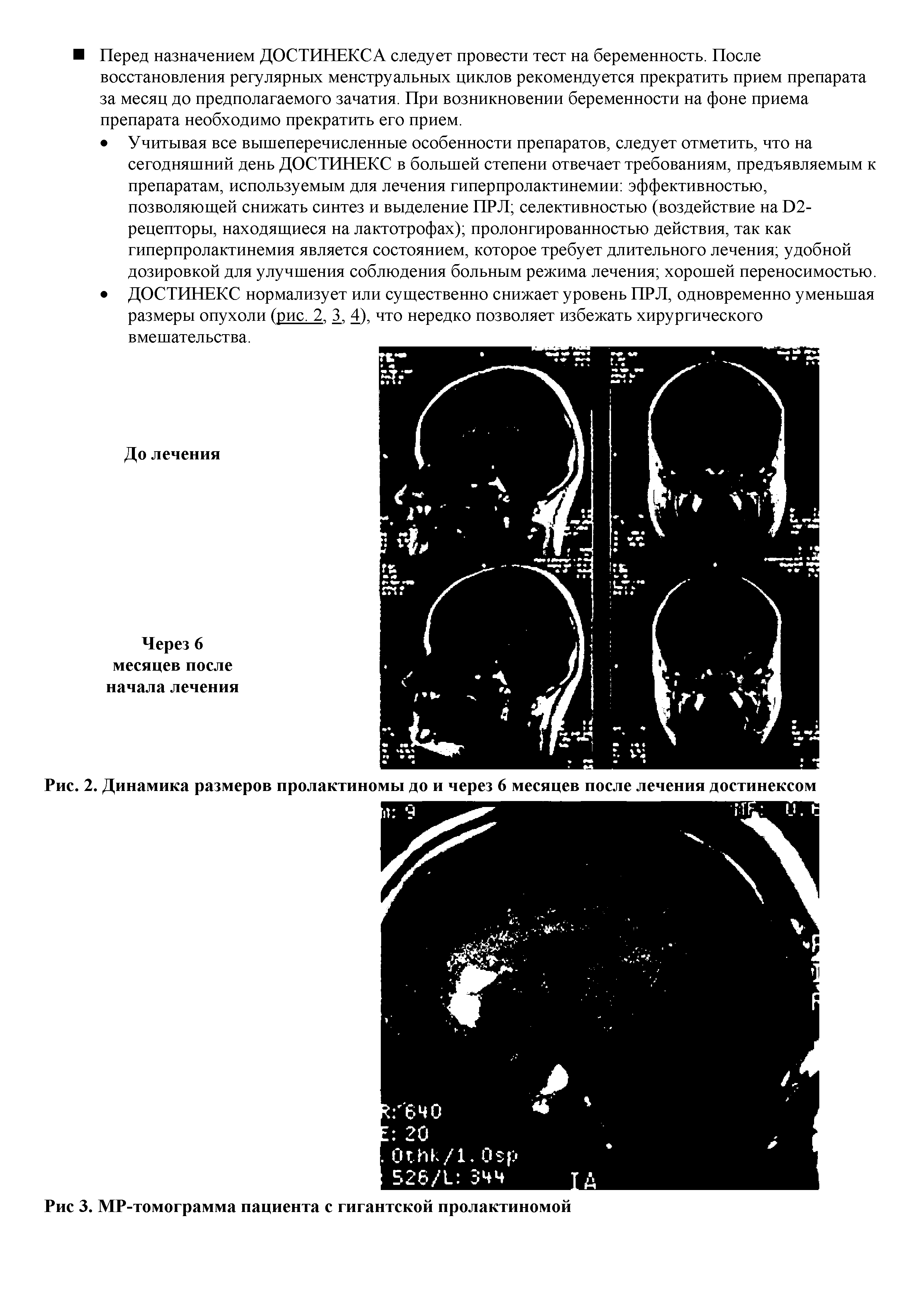 Рис. 2. Динамика размеров пролактиномы до и через 6 месяцев после лечения достинексом...