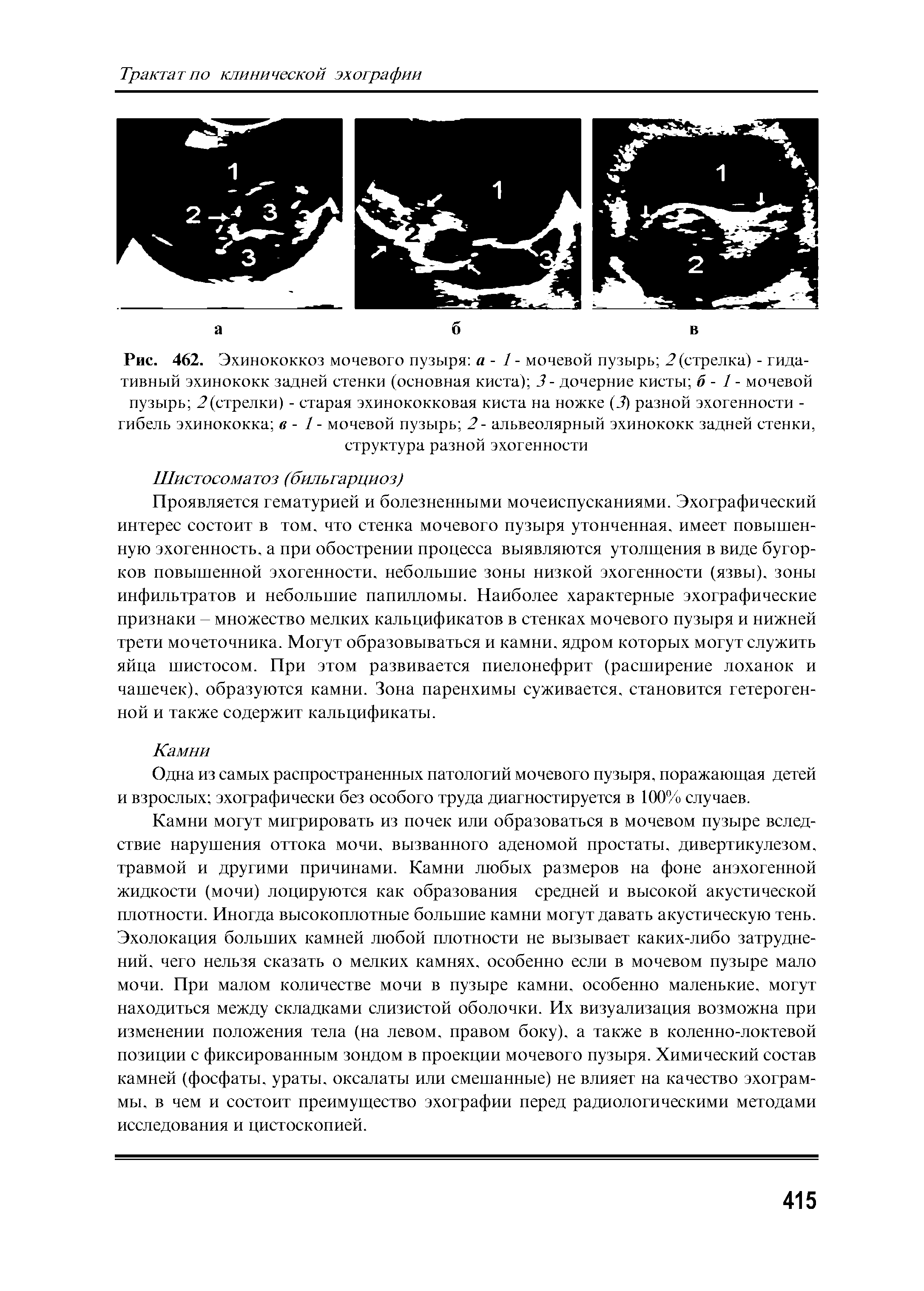 Рис. 462. Эхинококкоз мочевого пузыря а - 1 - мочевой пузырь 2 (стрелка) - гида-тивный эхинококк задней стенки (основная киста) 3 - дочерние кисты б - 1 - мочевой пузырь 2(стрелки) - старая эхинококковая киста на ножке (3) разной эхогенности -гибель эхинококка в - 1 - мочевой пузырь 2- альвеолярный эхинококк задней стенки, структура разной эхогенности...