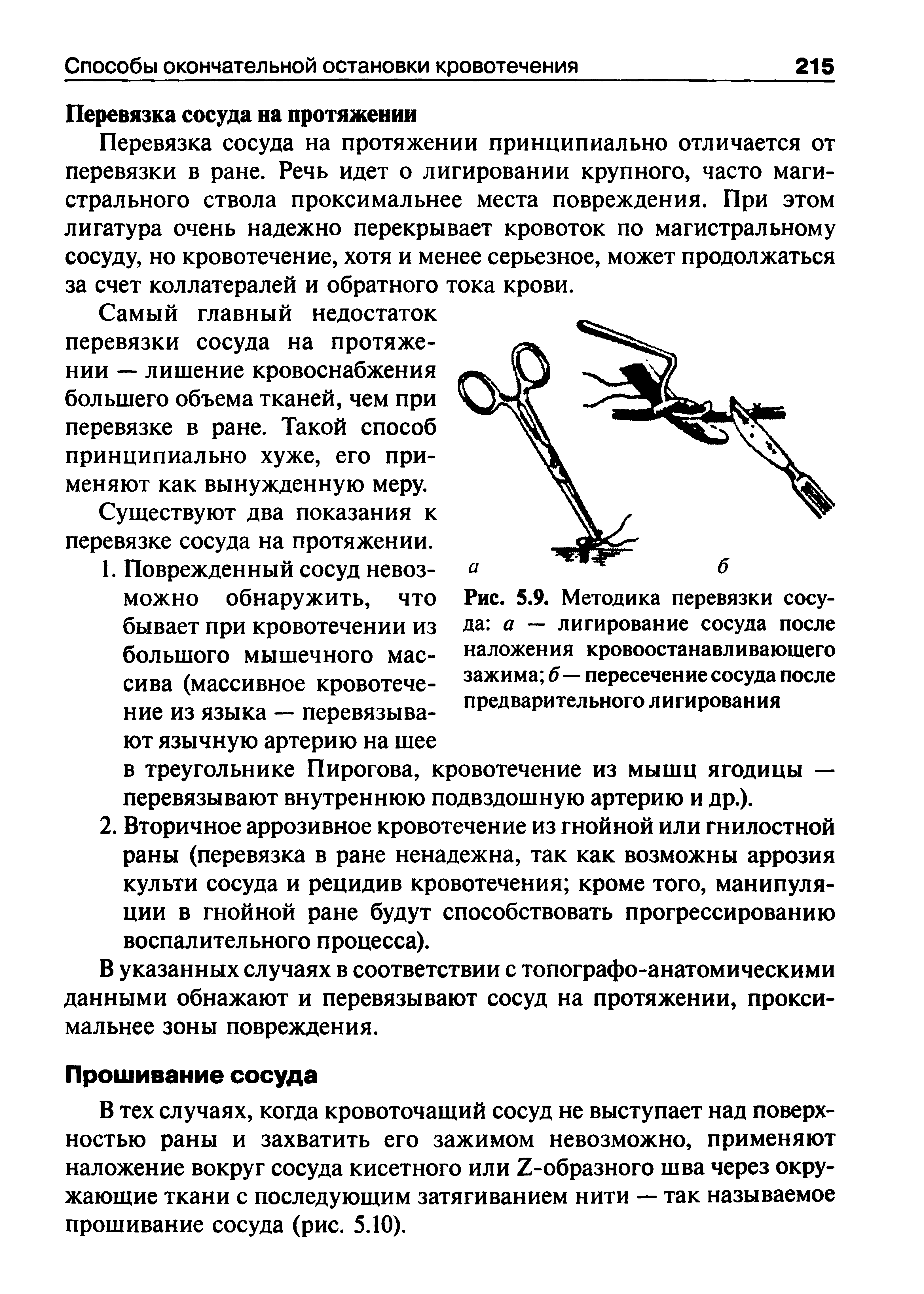 Рис. 5.9. Методика перевязки сосуда а — лигирование сосуда после наложения кровоостанавливающего зажима б — пересечение сосуда после предварительного лигирования...