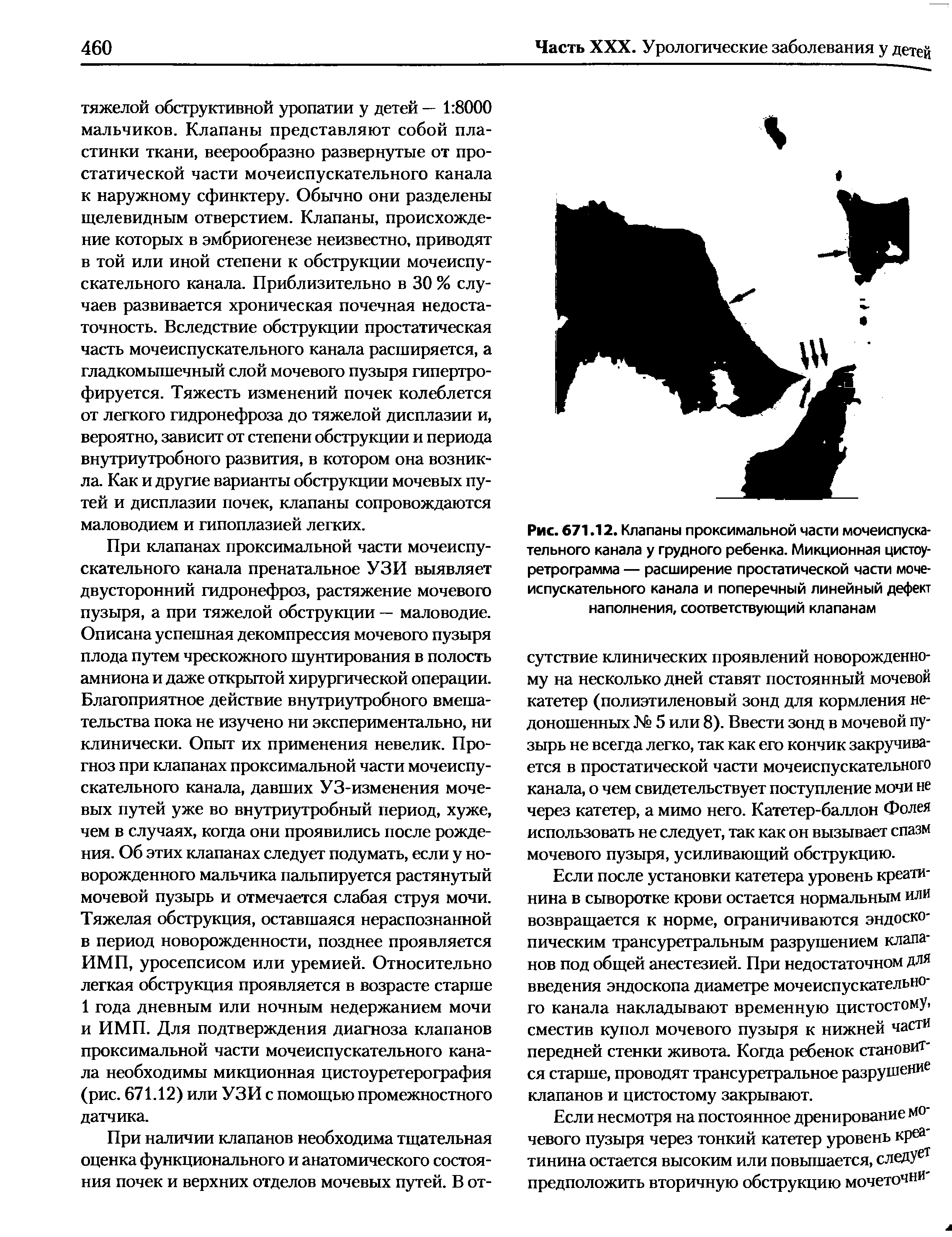 Рис. 671.12. Клапаны проксимальной части мочеиспускательного канала у грудного ребенка. Микционная цистоу-ретрограмма — расширение простатической части мочеиспускательного канала и поперечный линейный дефект наполнения, соответствующий клапанам...