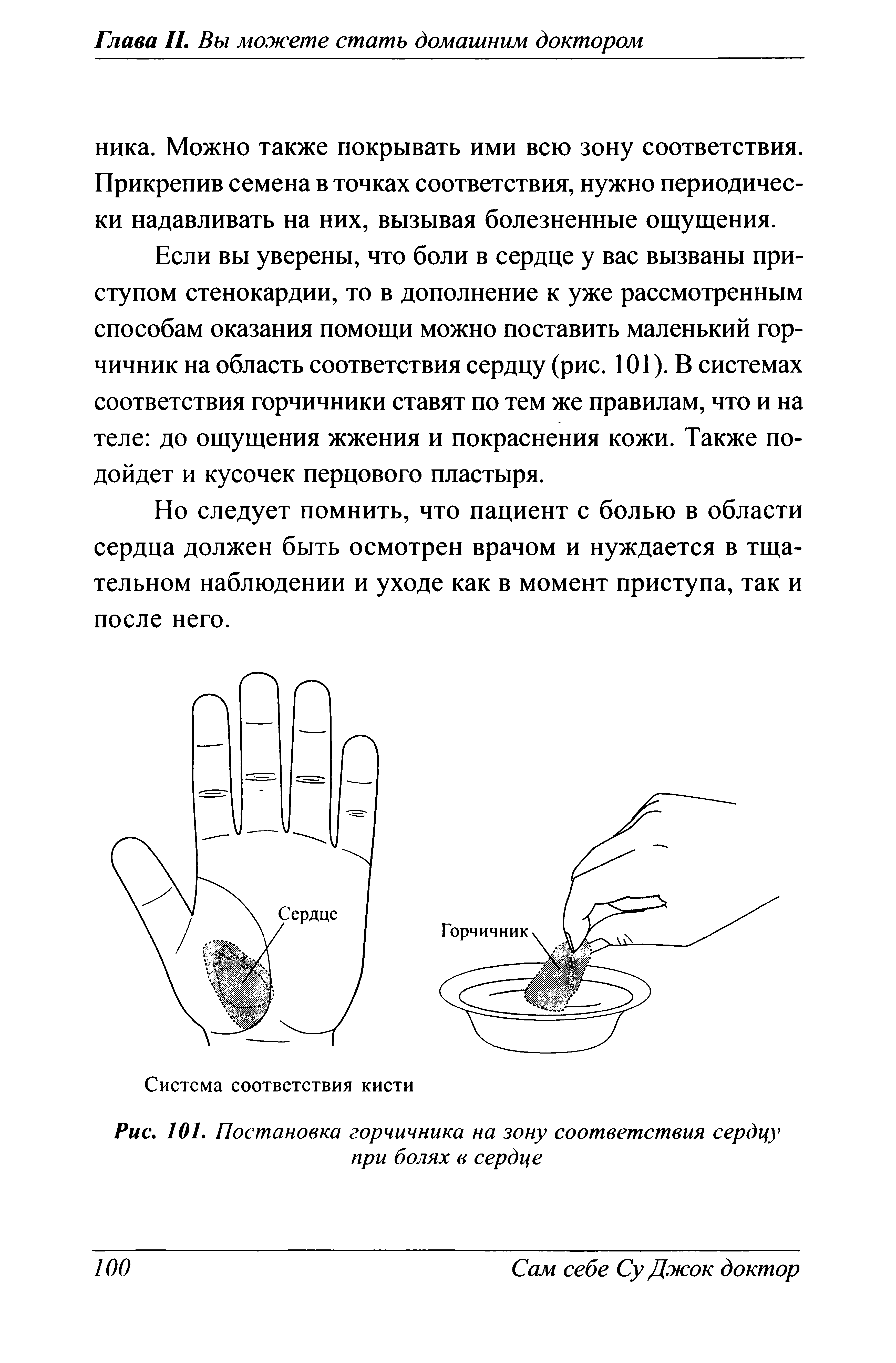 Рис. 101. Постановка горчичника на зону соответствия сердцу при болях в сердце...