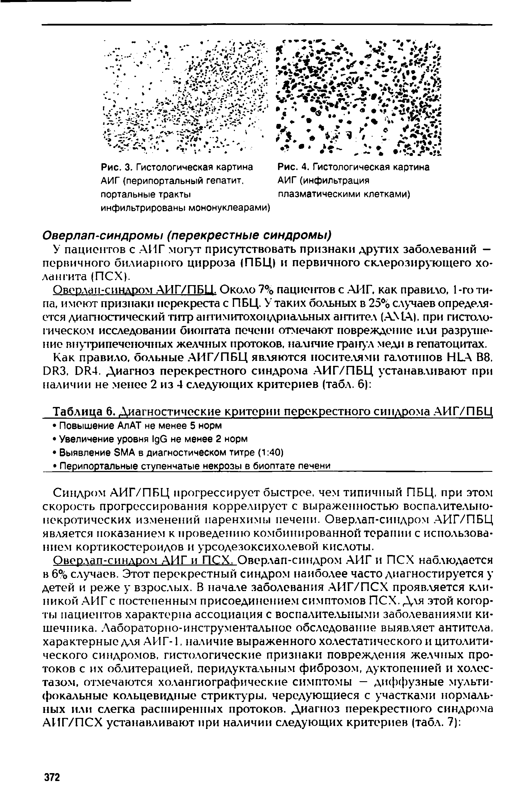 Рис. 3. Гистологическая картина АИГ (перипортальный гепатит, портальные тракты инфильтрированы мононуклеарами)...