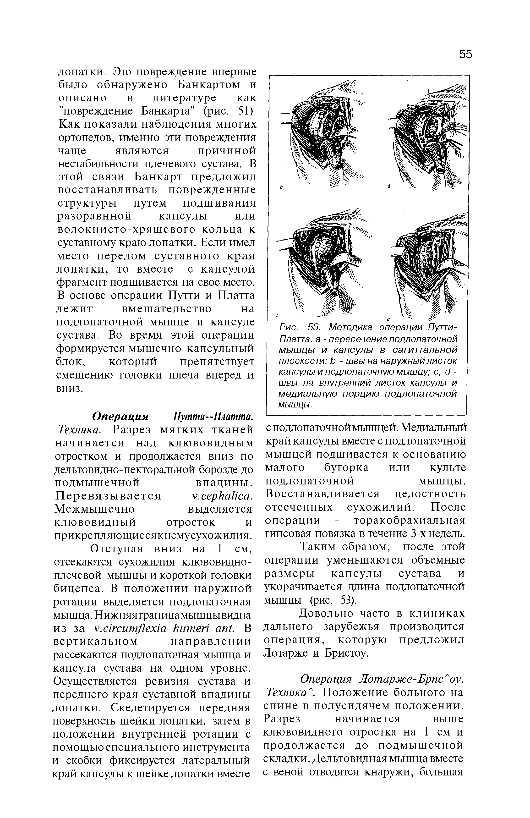 Рис. 53. Методика операции Путти-Платта. а - пересечение подлопаточной мышцы и капсулы в сагиттальной плоскости Ь - швы на наружный листок капсулы и подлопаточную мышцу с, с1 -швы на внутренний листок капсулы и медиальную порцию подлопаточной мышцы.