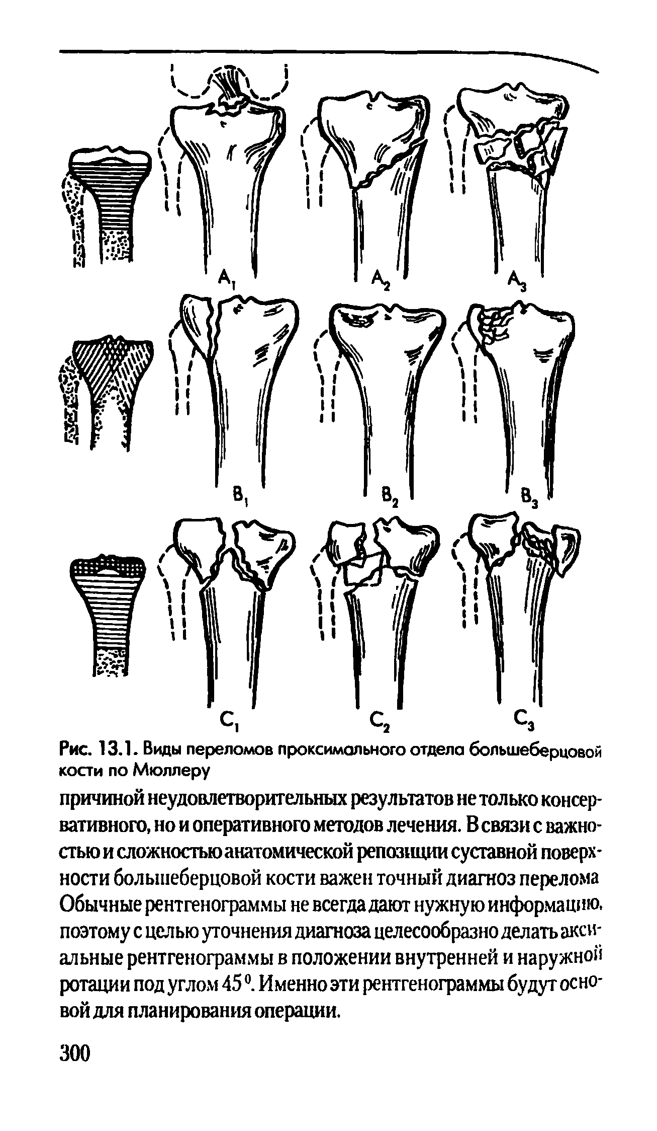 Рис. 13.1. Виды переломов проксимального отдела большеберцовой кости по Мюллеру...