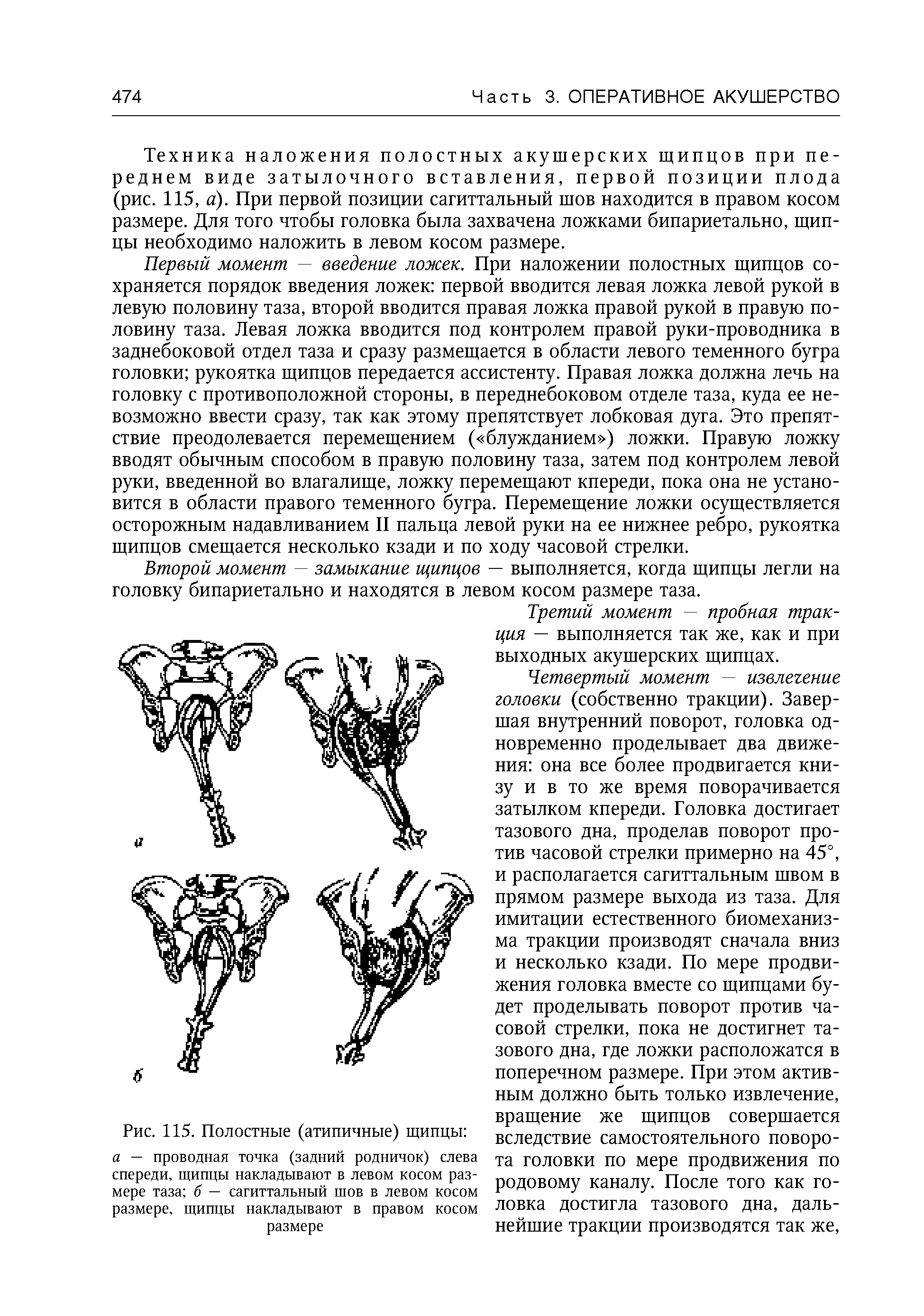 Рис. 115. Полостные (атипичные) щипцы а — проводная точка (задний родничок) слева спереди, щипцы накладывают в левом косом размере таза б — сагиттальный шов в левом косом размере, щипцы накладывают в правом косом размере...