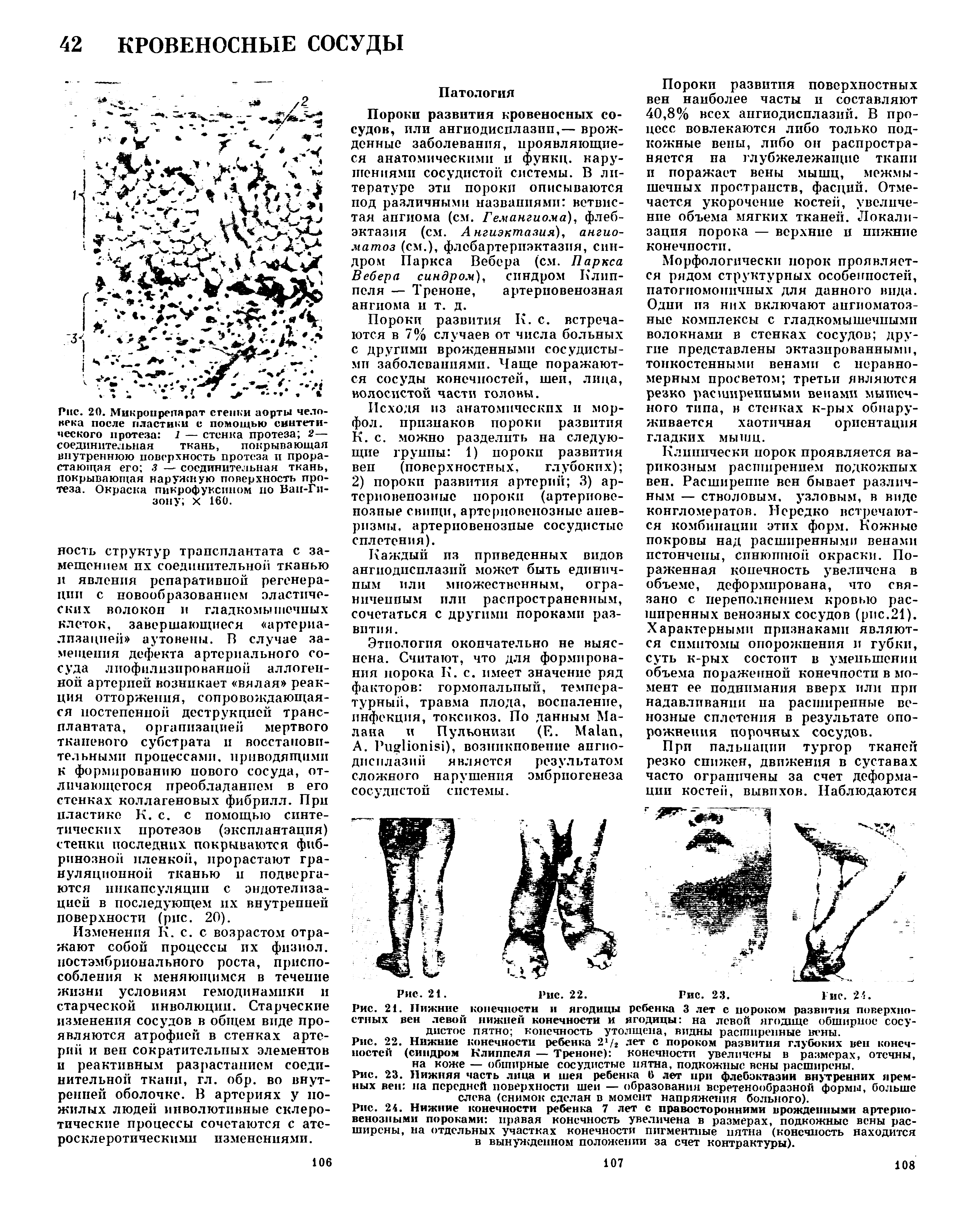 Рис. 22. Нижние конечности ребенка 2 /2 лет с пороком развития глубоких вен конечностей (синдром Клиппеля — Треноне) конечности увеличены в размерах, отечны, на коже — обширные сосудистые иятна, подкожные вены расширены.