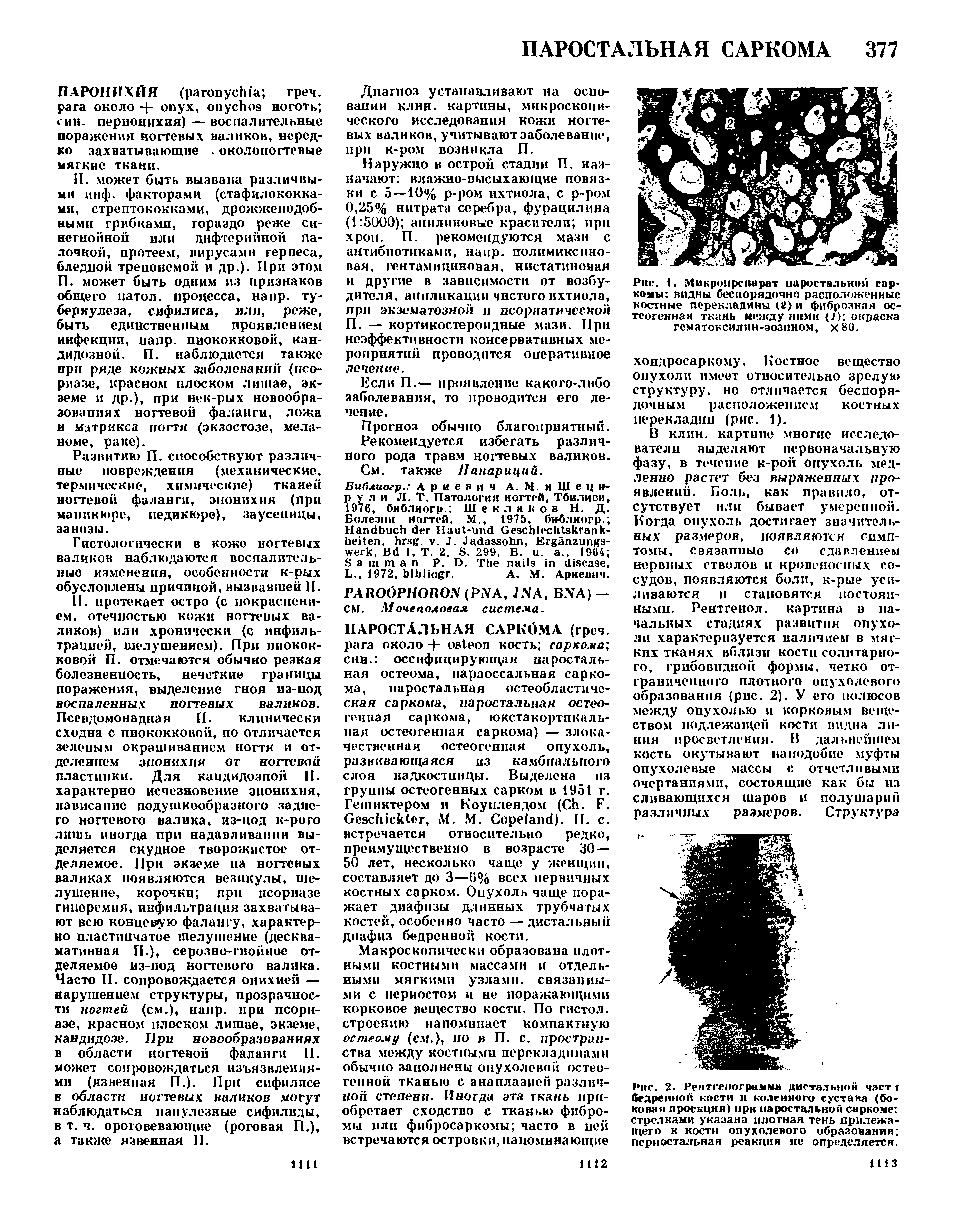 Рис. 1. Микро препарат паростальной саркомы видны беспорядочно расположенные костные перекладины (2) и фиброзная остеогенная ткань между ними (7) окраска гематоксилин-эозпном, х80.