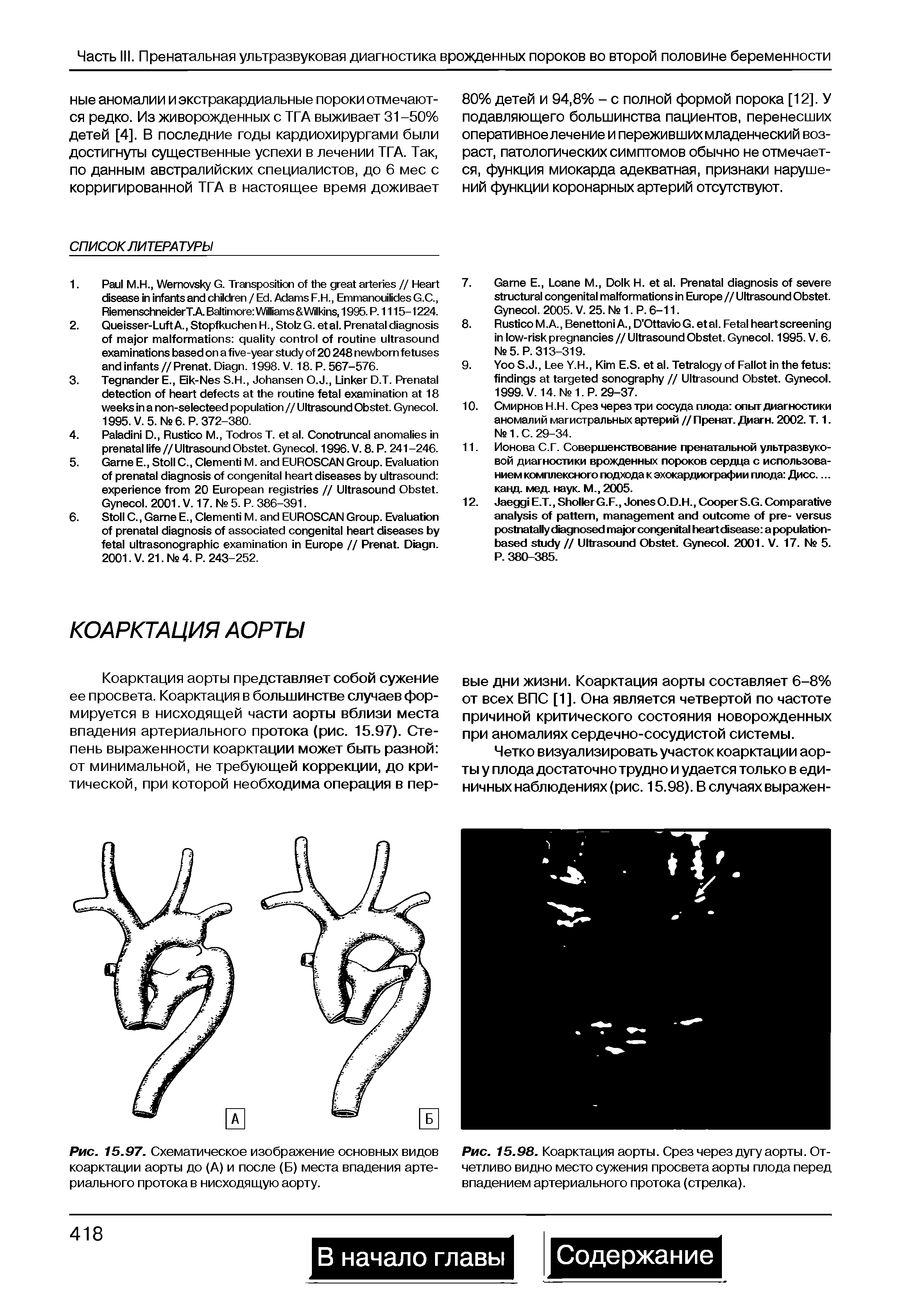 Рис. 15.98. Коарктация аорты. Срез через дугу аорты. Отчетливо видно место сужения просвета аорты плода перед впадением артериального протока (стрелка).