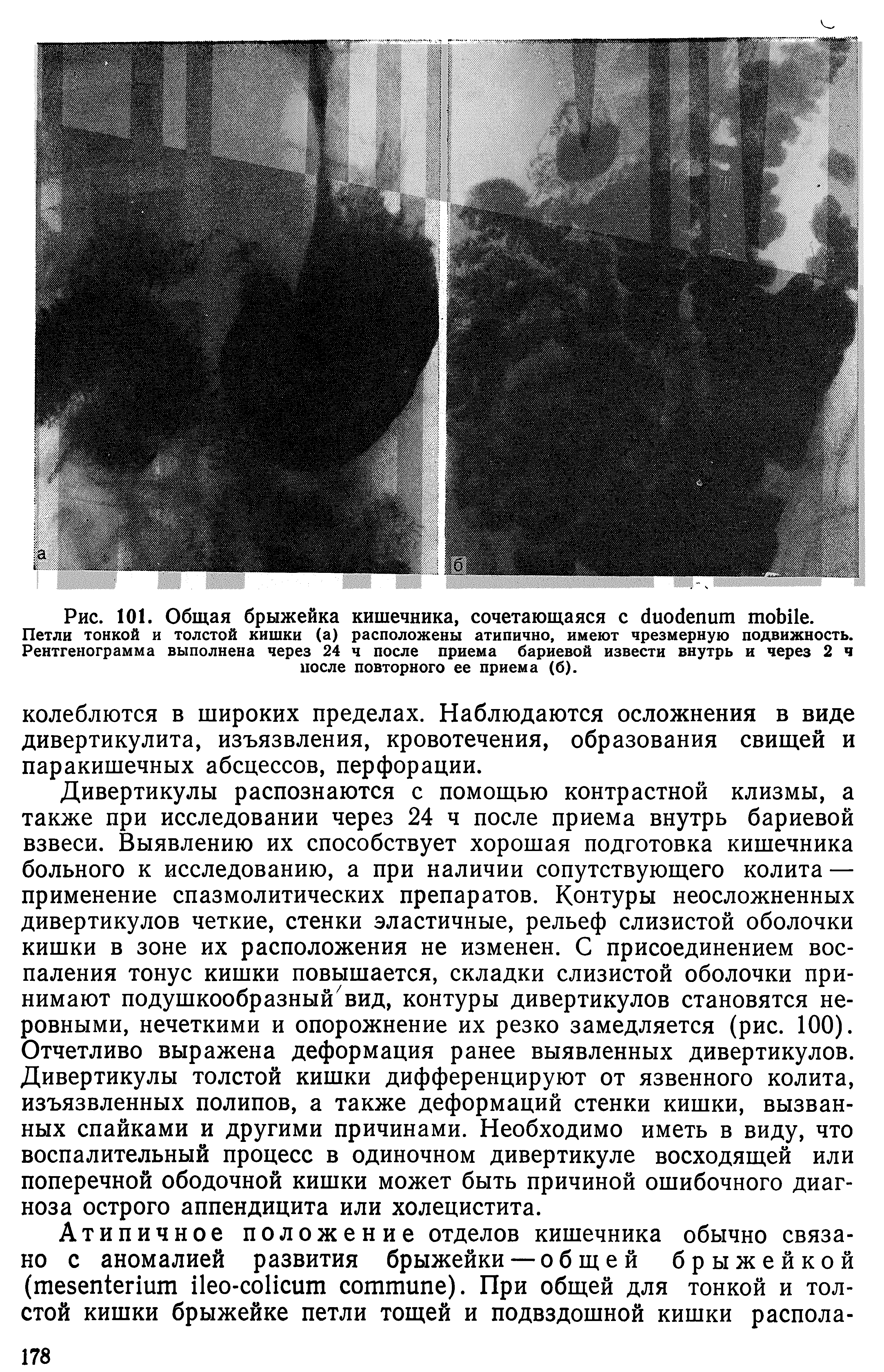 Рис. 101. Общая брыжейка кишечника, сочетающаяся с .