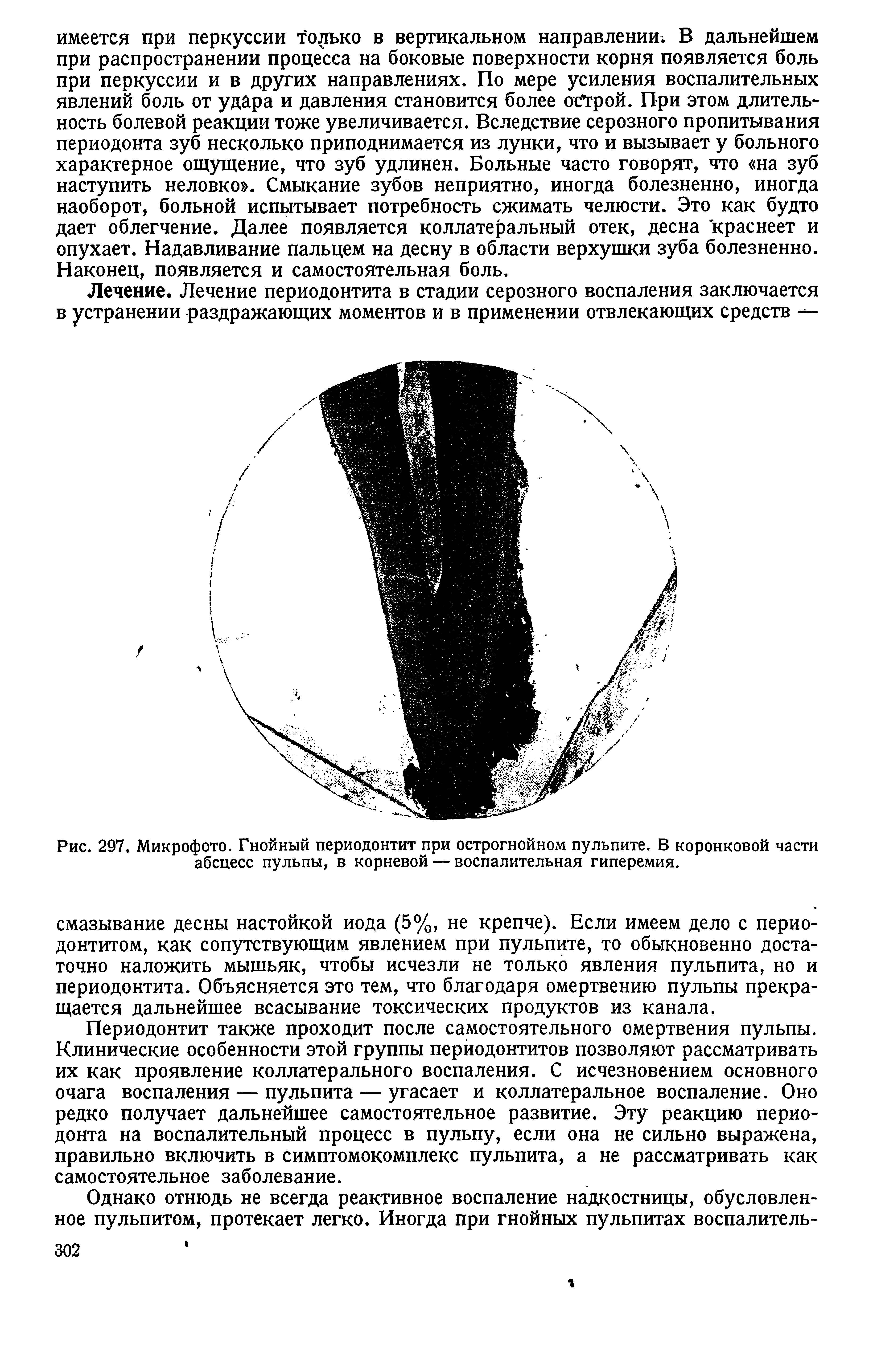 Рис. 297. Микрофото. Гнойный периодонтит при острогнойном пульпите. В коронковой части абсцесс пульпы, в корневой — воспалительная гиперемия.