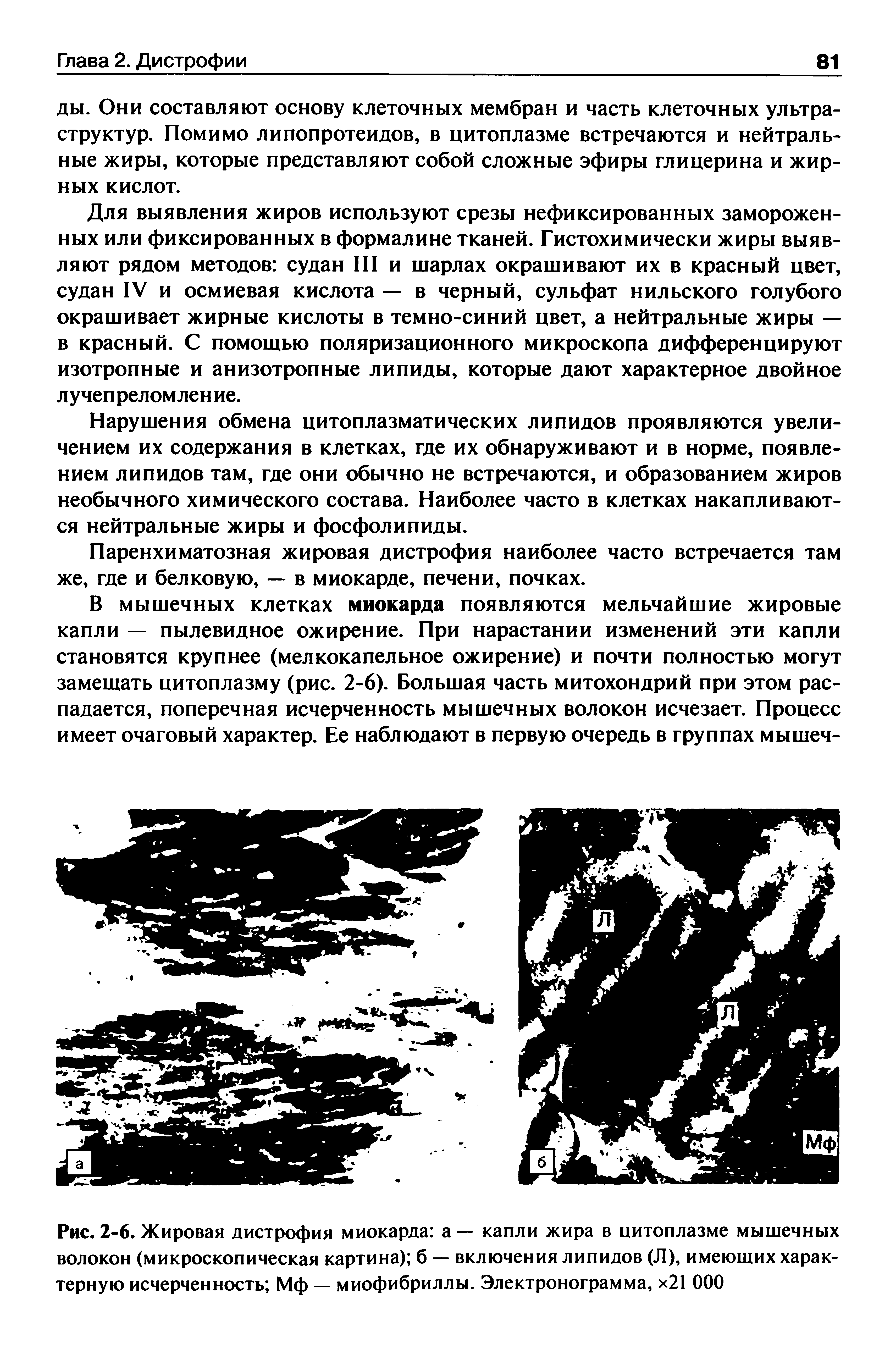 Рис. 2-6. Жировая дистрофия миокарда а — капли жира в цитоплазме мышечных волокон (микроскопическая картина) б — включения липидов (Л), имеющих характерную исчерченность Мф — миофибриллы. Электронограмма, х21 ООО...