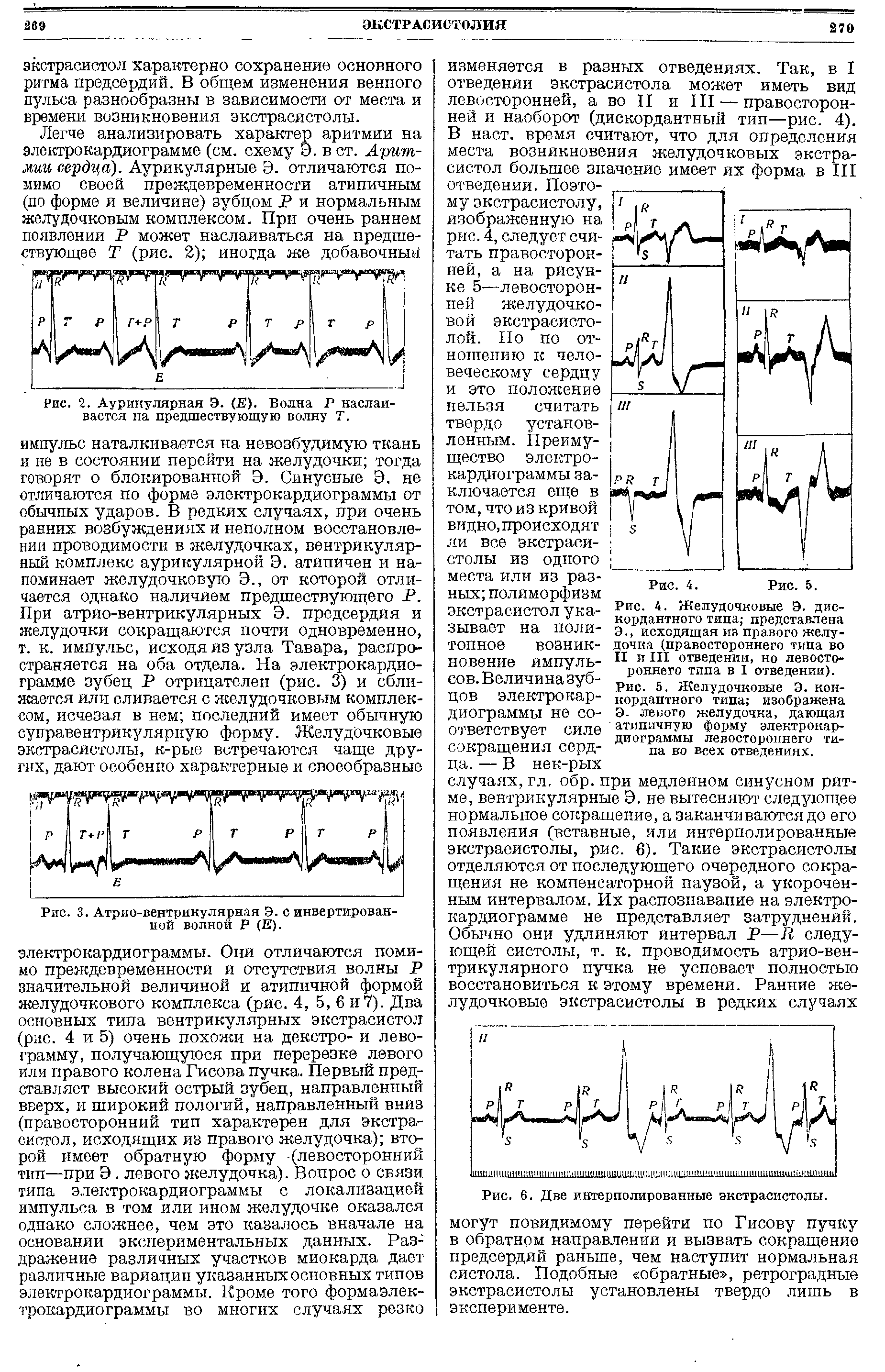 Рис. 5. Желудочковые Э. кон-кордантного типа изображена Э- левого желудочка, дающая атипичную форму электрокардиограммы левостороннего типа во всех отведениях.