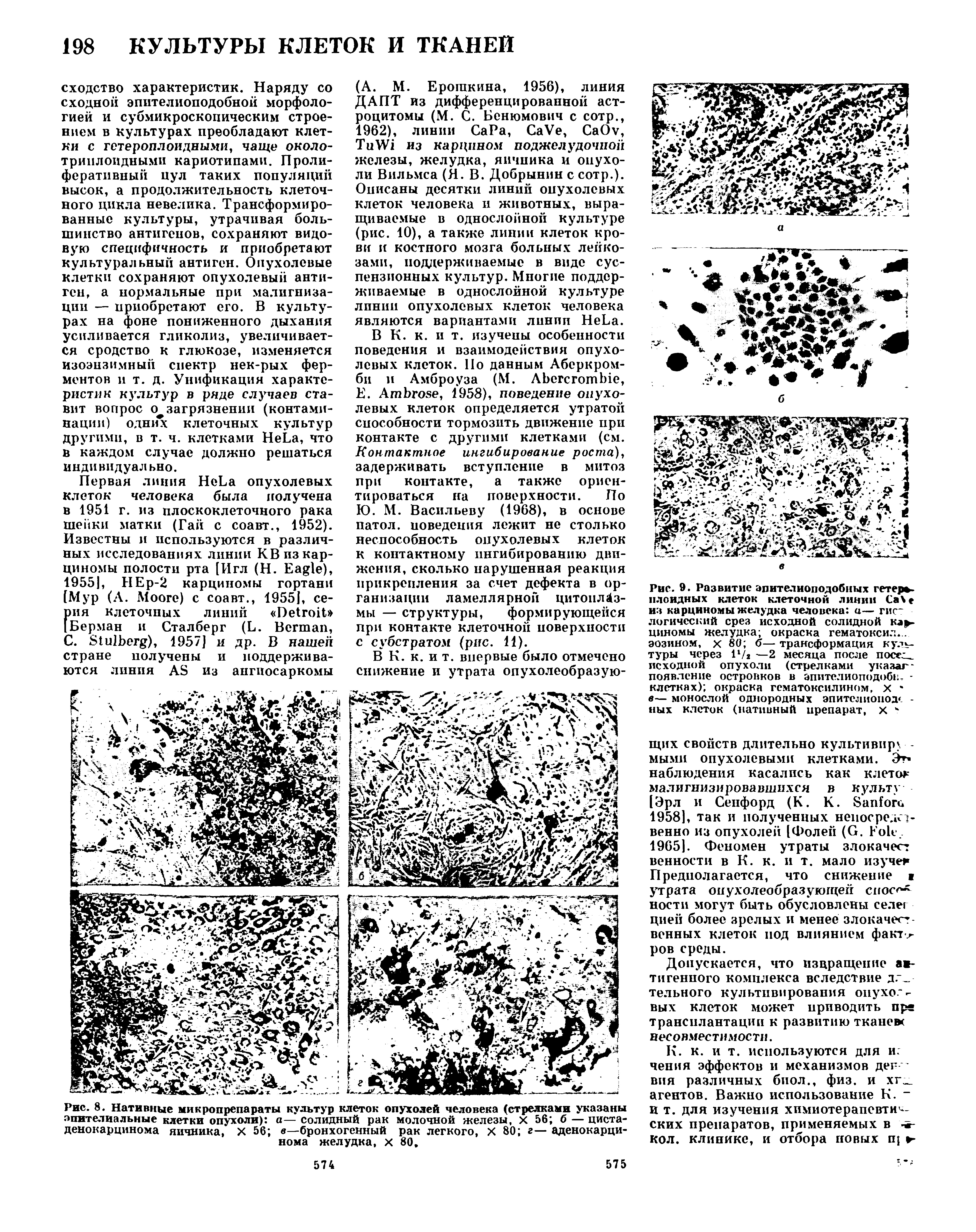 Рис. 8. Нативные микропрепараты культур клеток опухолей человека (стрелками указаны эпителиальные клетки опухоли) а— солидный рак молочной железы, X 56 б — циста-денокарцинома яичника, X 56 в—бронхогенный рак легкого, X 80 г— аденокарцинома желудка, X 80.