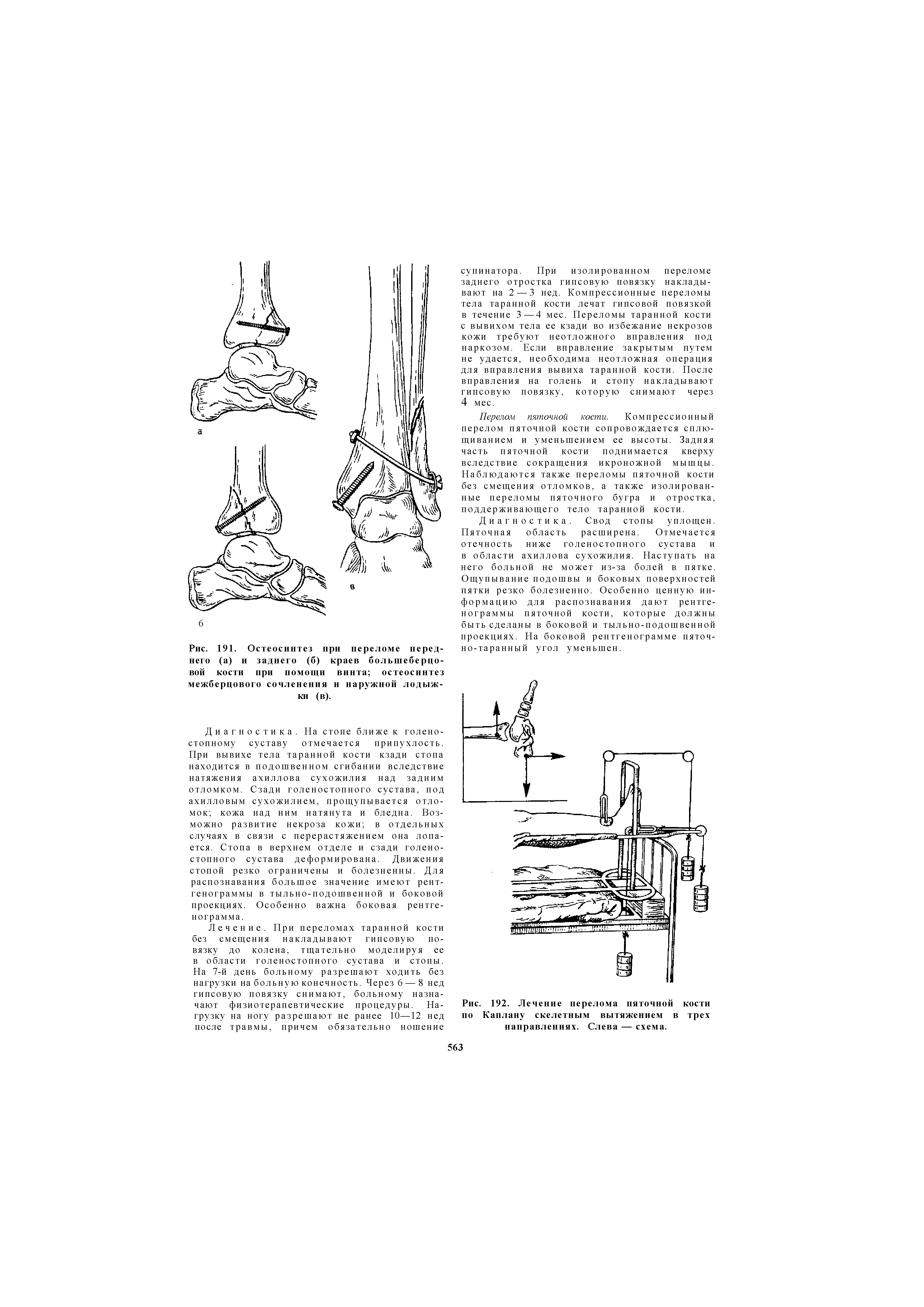 Рис. 192. Лечение перелома пяточной кости по Каплану скелетным вытяжением в трех направлениях. Слева — схема.