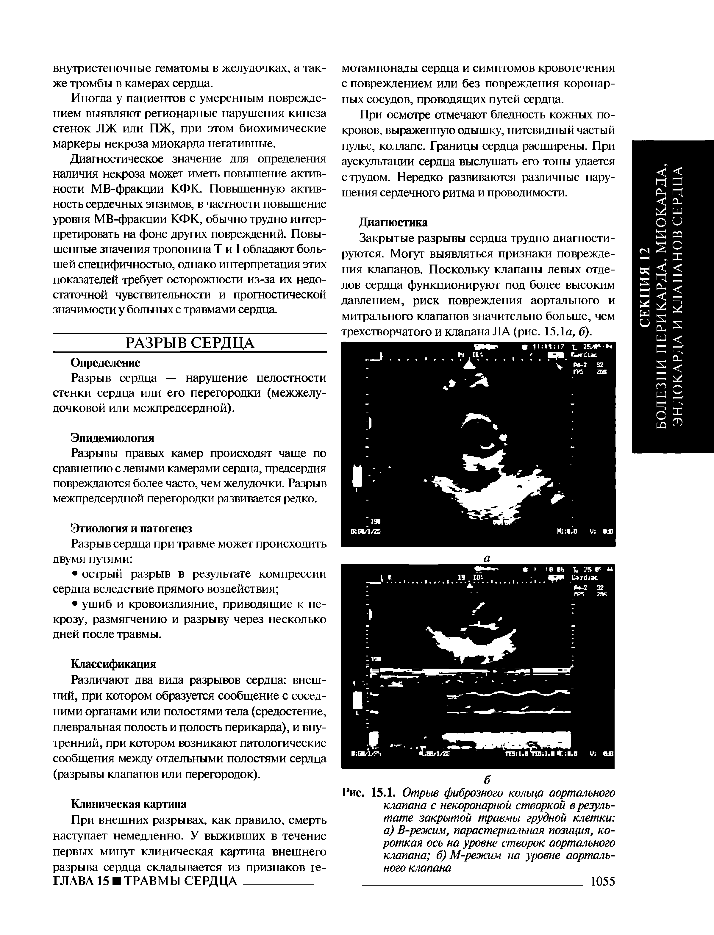 Рис. 15.1. Отрыв фиброзного кольца аортального клапана с некоронарной створкой в результате закрытой травмы грудной клетки а) В-режим, парастернальная позиция, короткая ось на уровне створок аортального клапана б) М-режим на уровне аортального клапана...