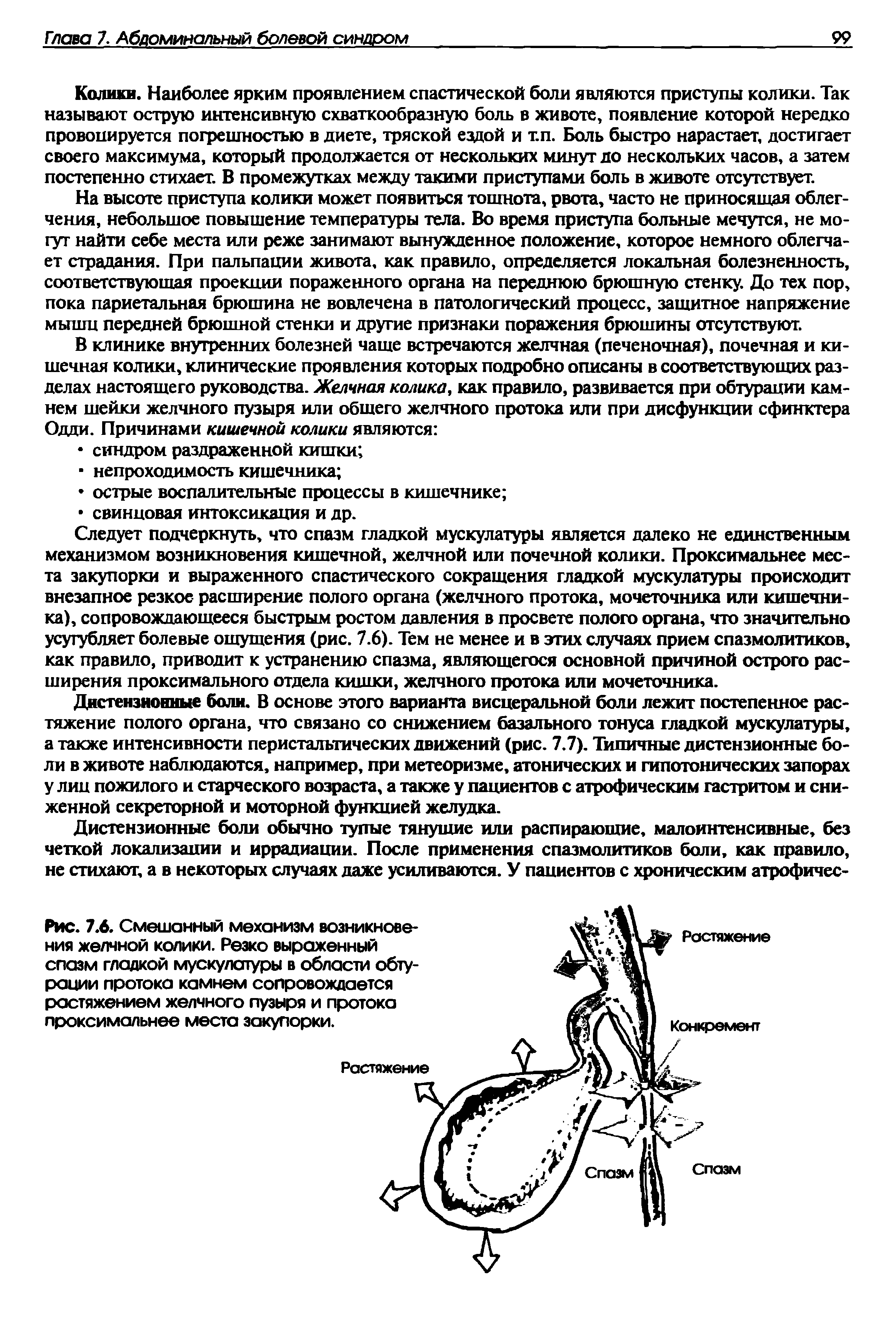 Рис. 7.6. Смешанный механизм возникновения желчной колики. Резко выраженный спазм гладкой мускулатуры в области обтурации протока камнем сопровождается растяжением желчного пузыря и протока проксимальнее места закупорки.