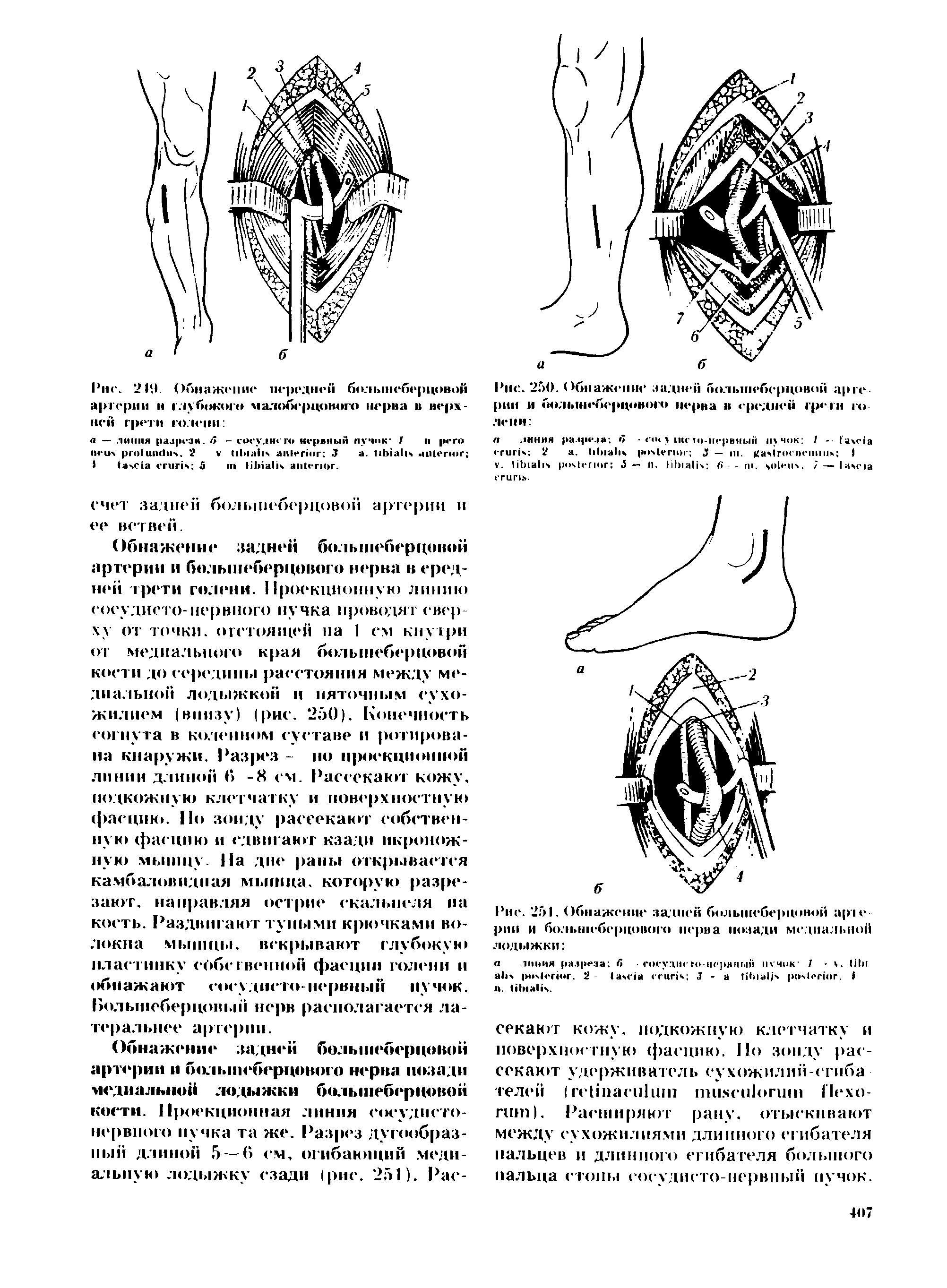 Рис. 250. Обнажение задней большеберцовой артерии и большеберцового нерва в е ц-дцей грет го. ...